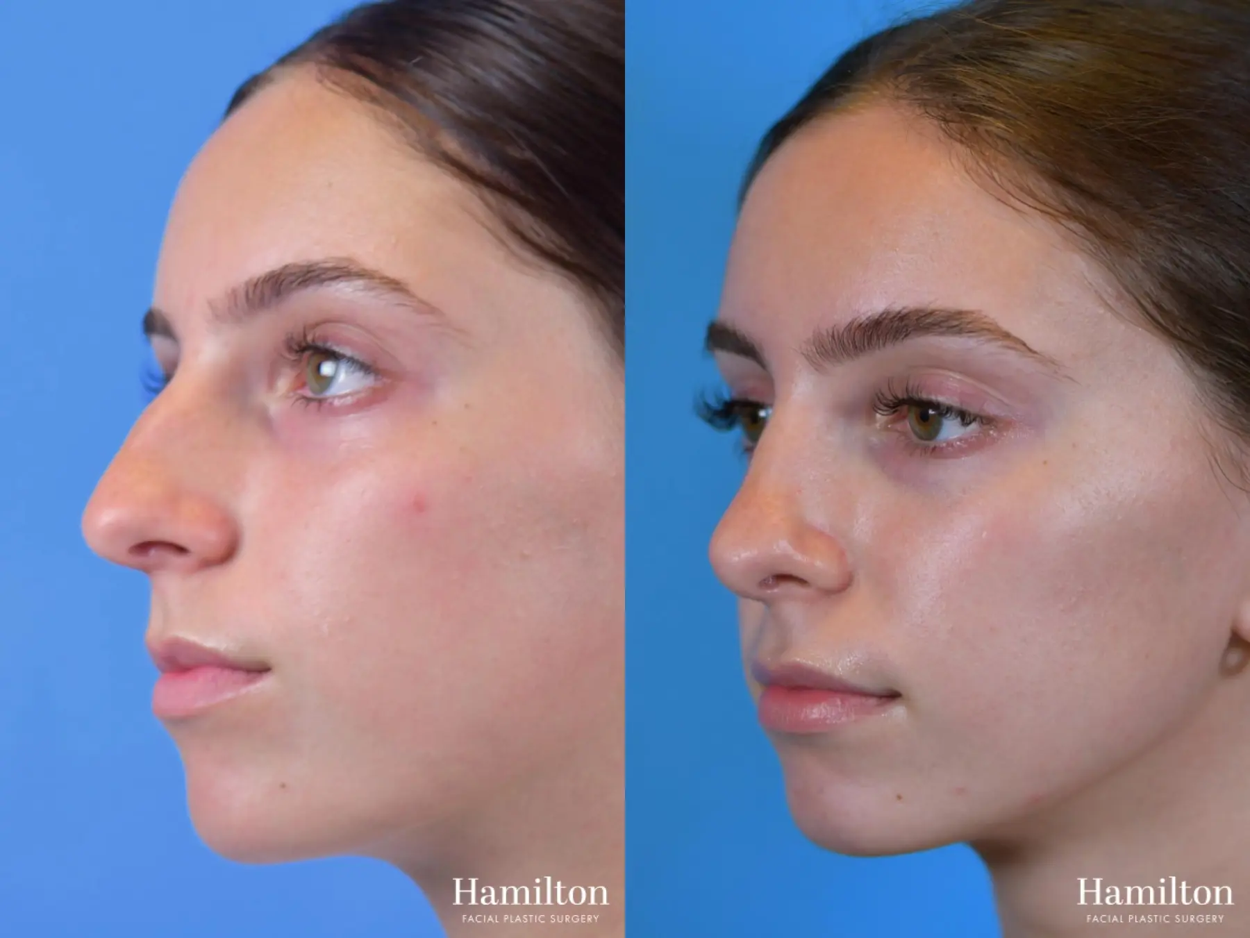 Rhinoplasty: Patient 1 - Before and After 2