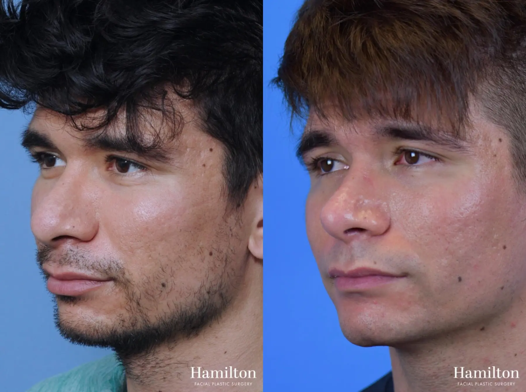 Rhinoplasty: Patient 9 - Before and After 5