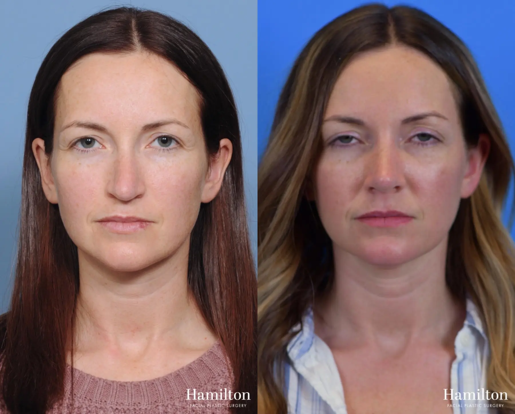 Rhinoplasty: Patient 8 - Before and After 3