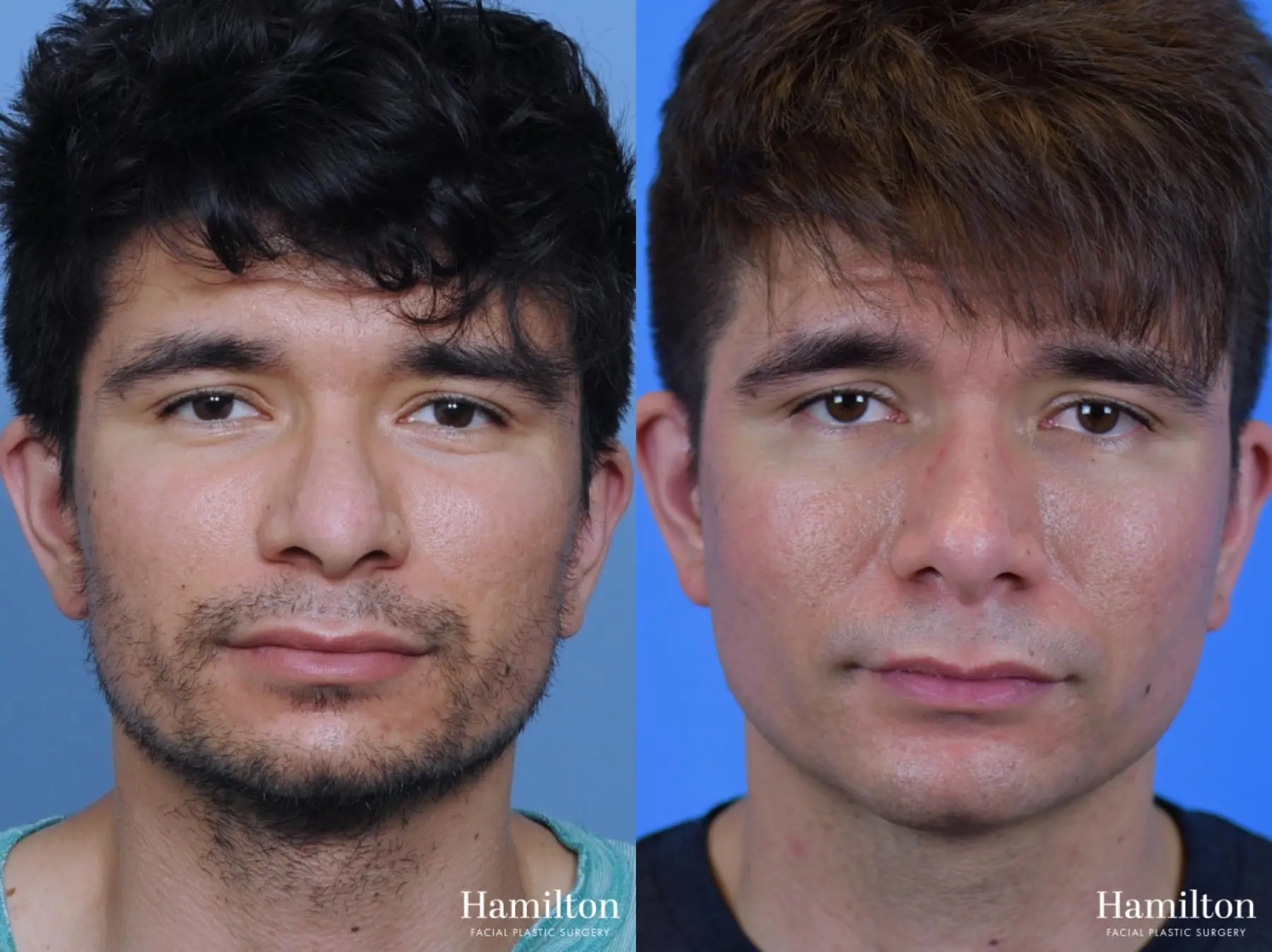 Rhinoplasty: Patient 19 - Before and After 3