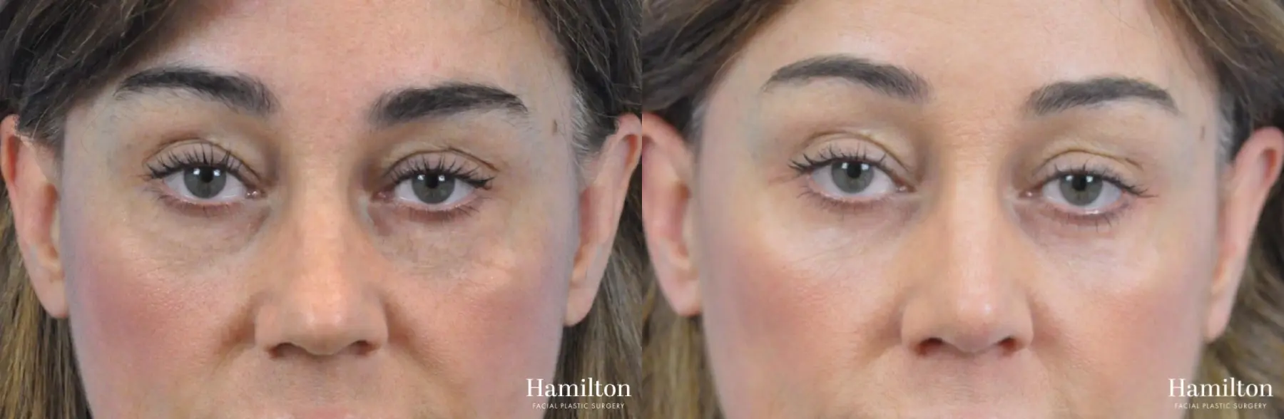 Rhinoplasty: Patient 38 - Before and After 5