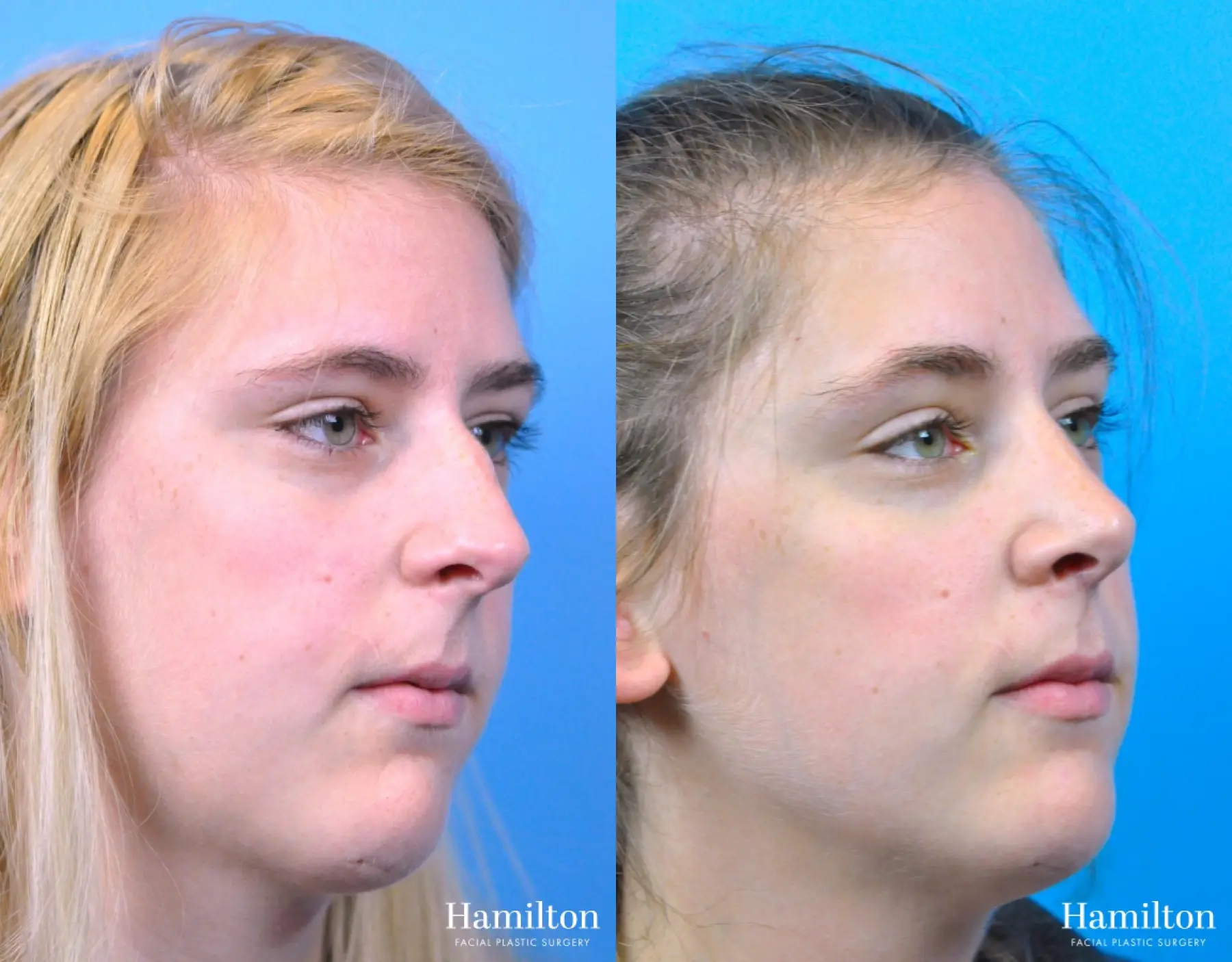 Rhinoplasty: Patient 50 - Before and After 3