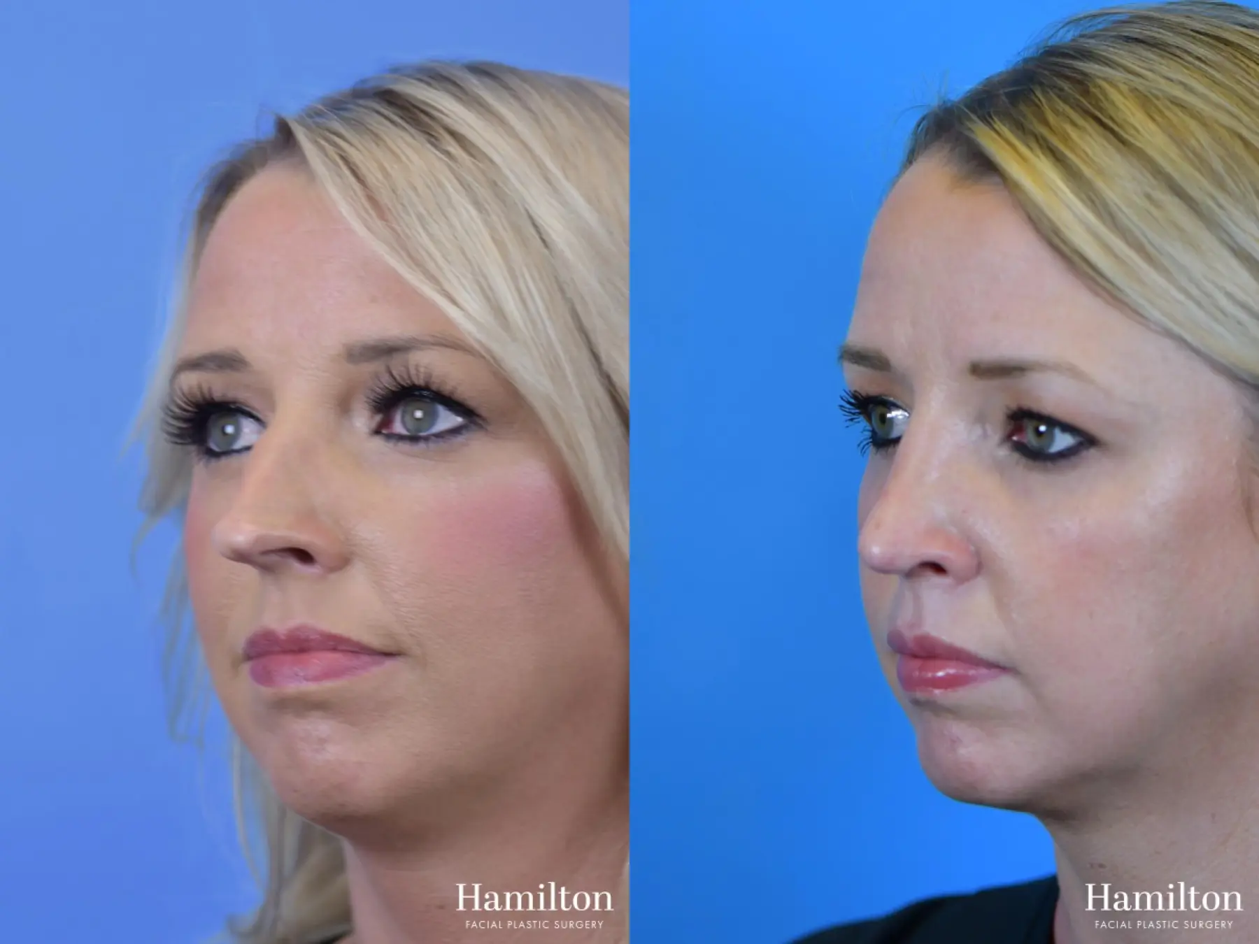 Rhinoplasty: Patient 10 - Before and After 5
