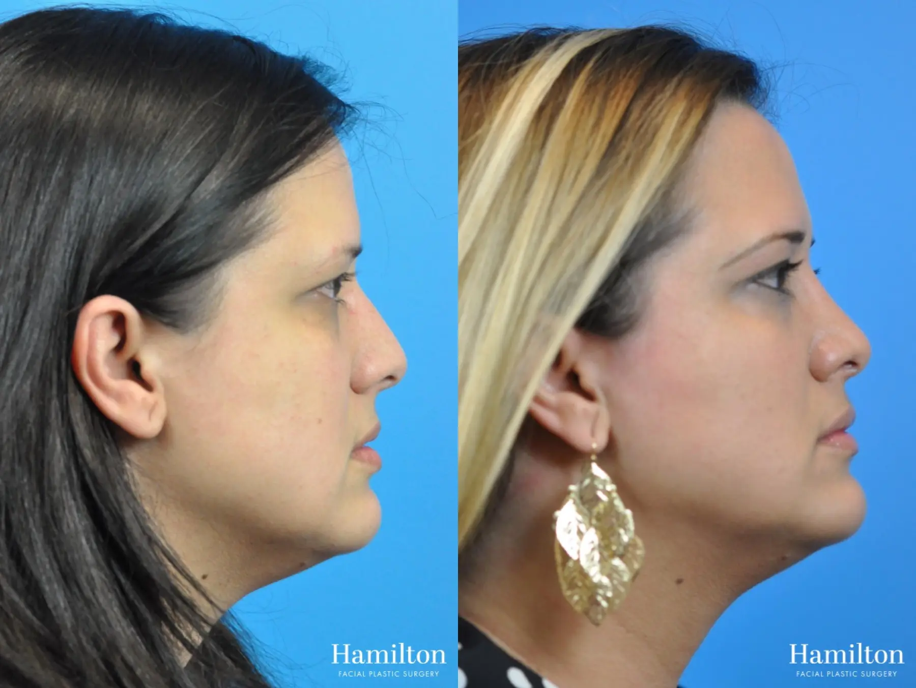Rhinoplasty: Patient 41 - Before and After 2