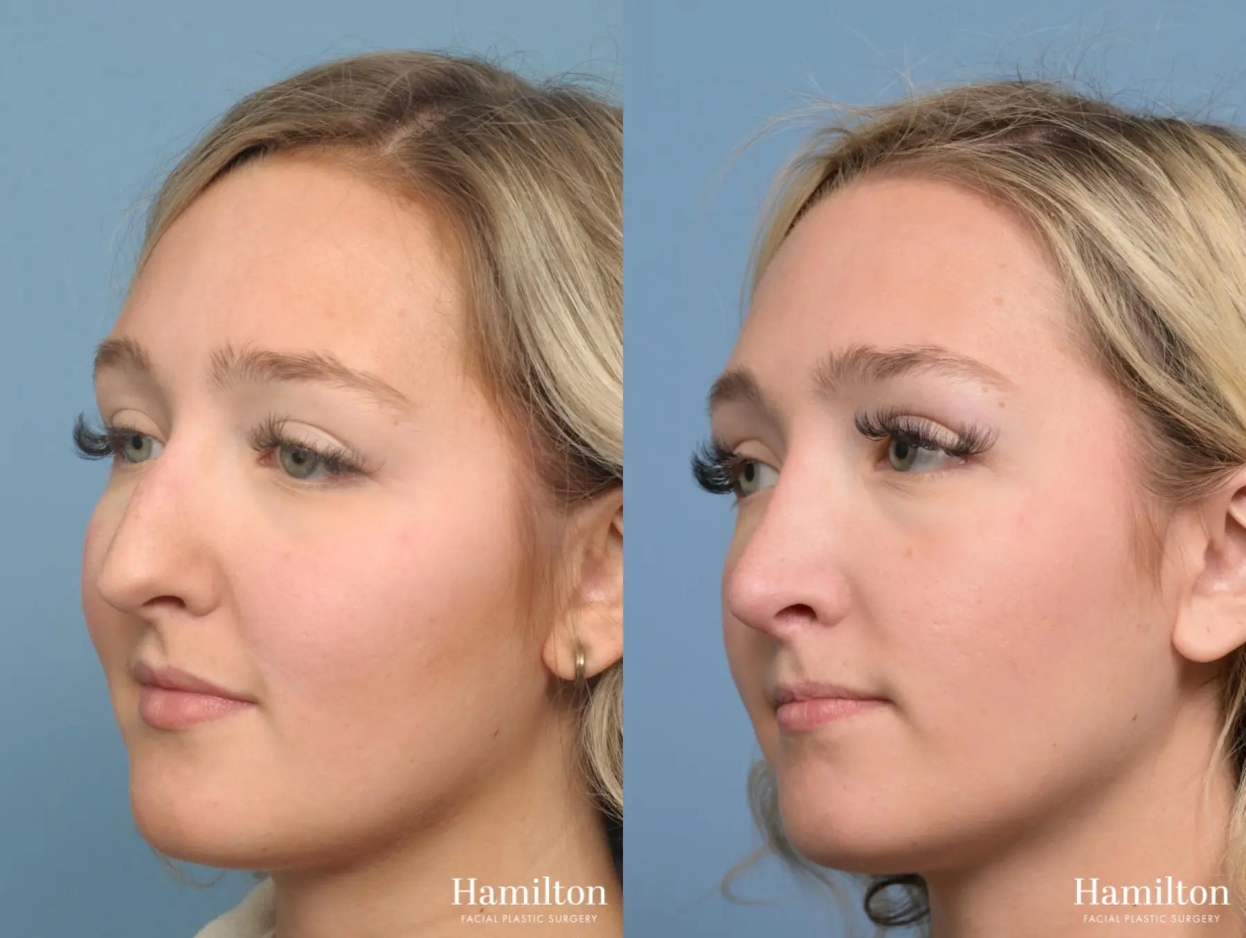 Rhinoplasty: Patient 7 - Before and After 2