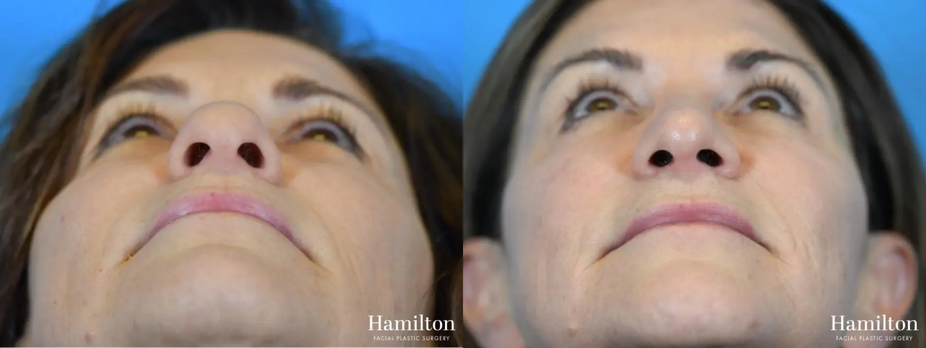 Rhinoplasty: Patient 14 - Before and After 6