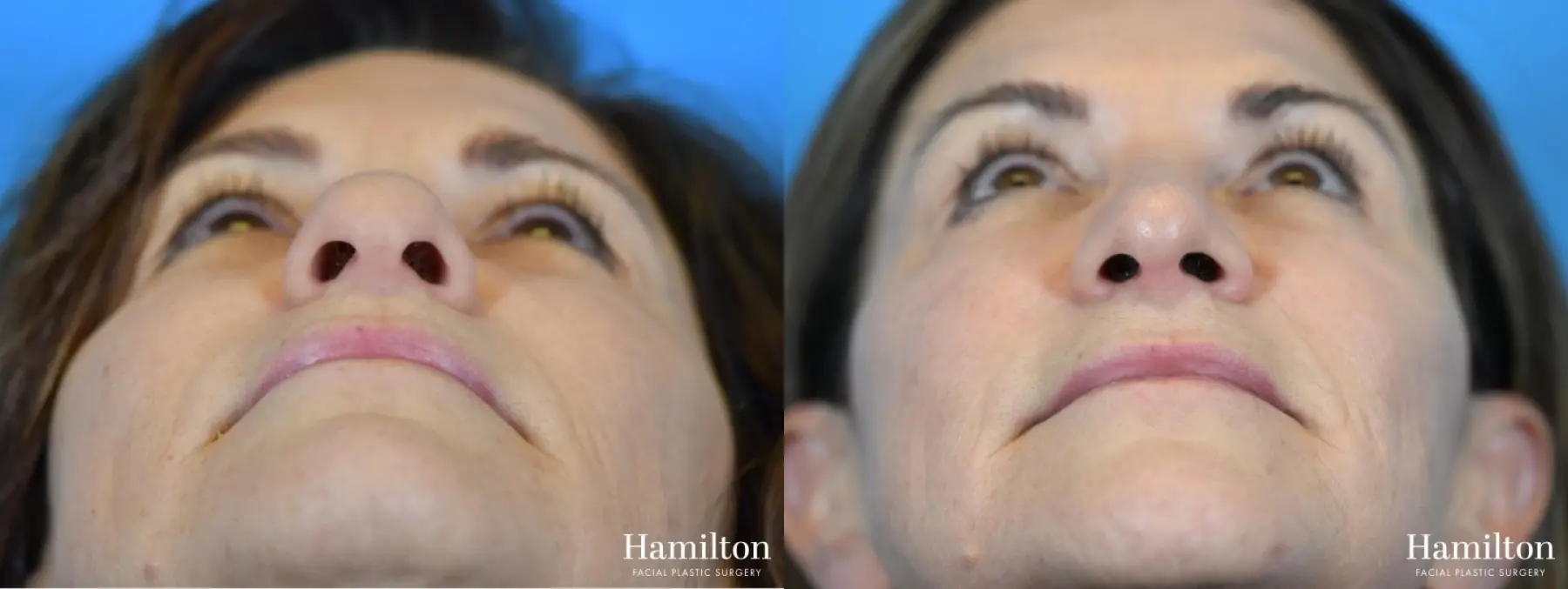 Rhinoplasty: Patient 22 - Before and After 6