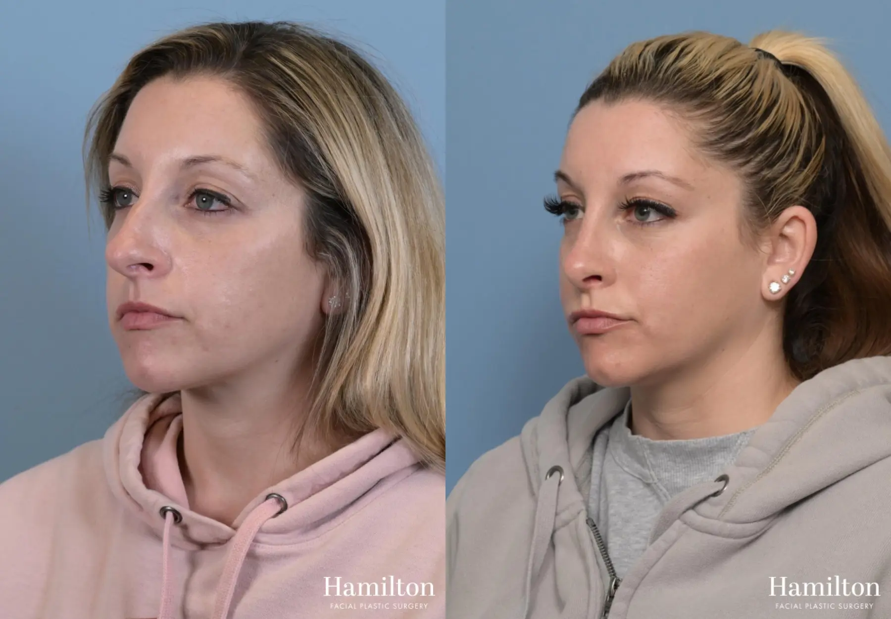 Rhinoplasty: Patient 11 - Before and After 4