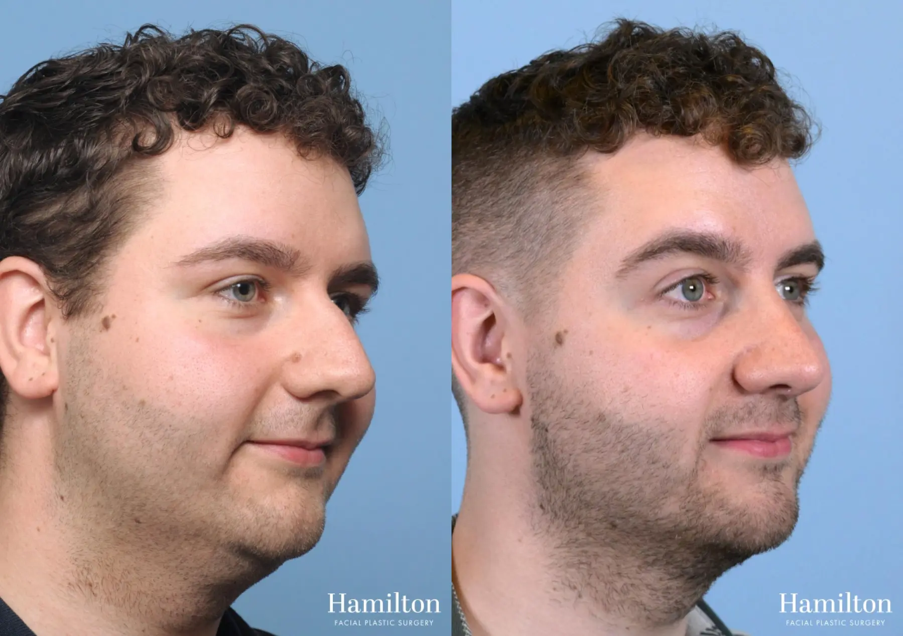 Rhinoplasty: Patient 6 - Before and After 1