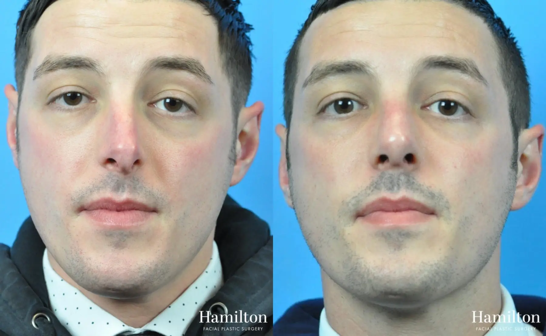 Rhinoplasty: Patient 40 - Before and After 1