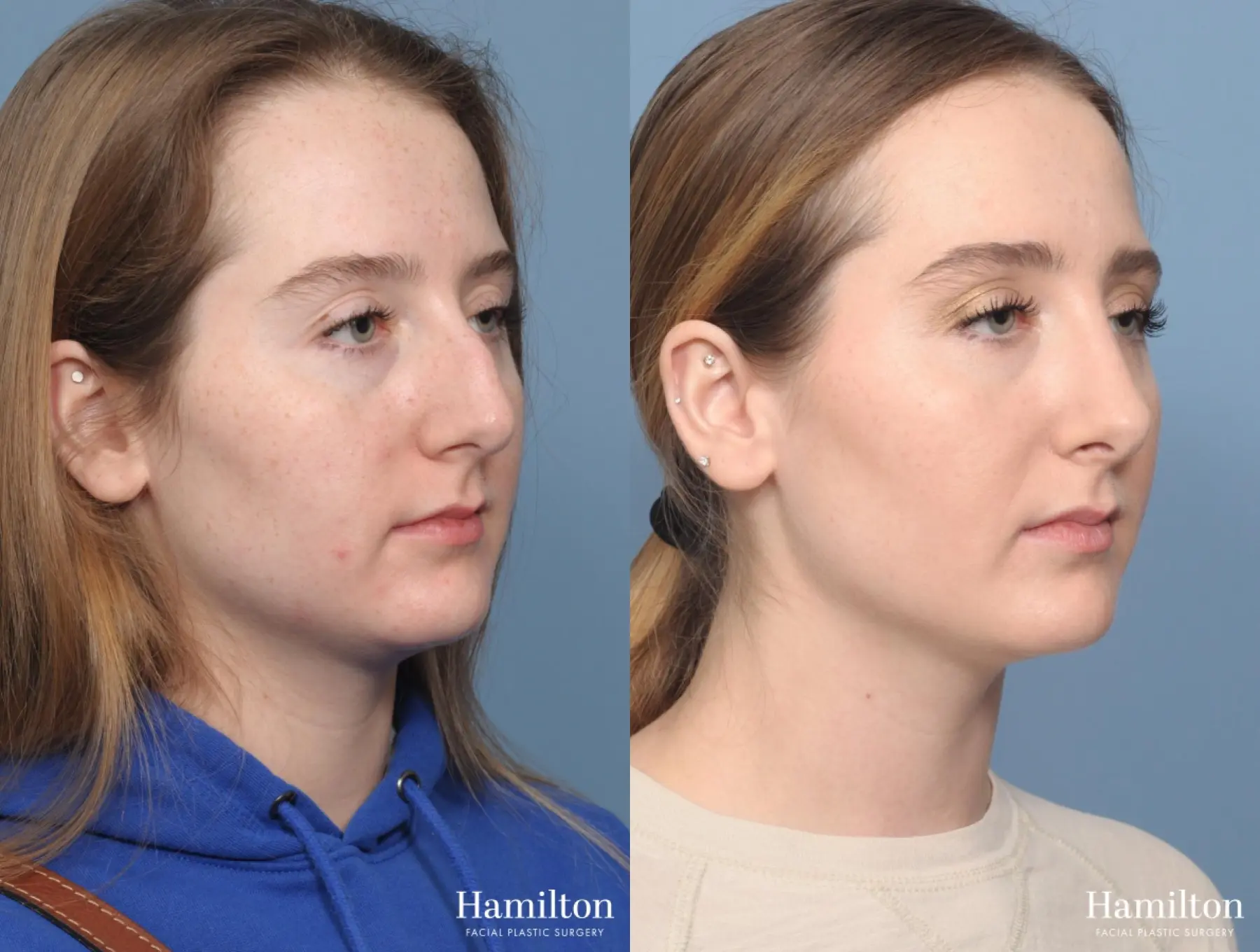 Rhinoplasty: Patient 1 - Before and After  