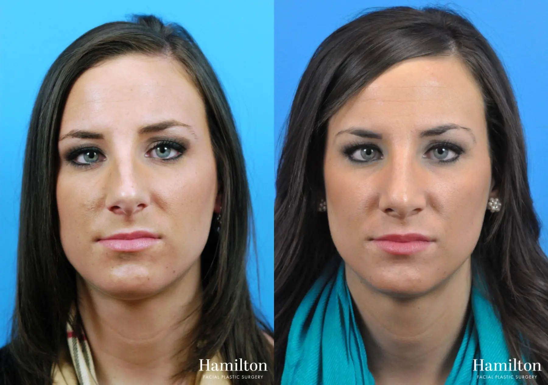 Rhinoplasty: Patient 27 - Before and After 4