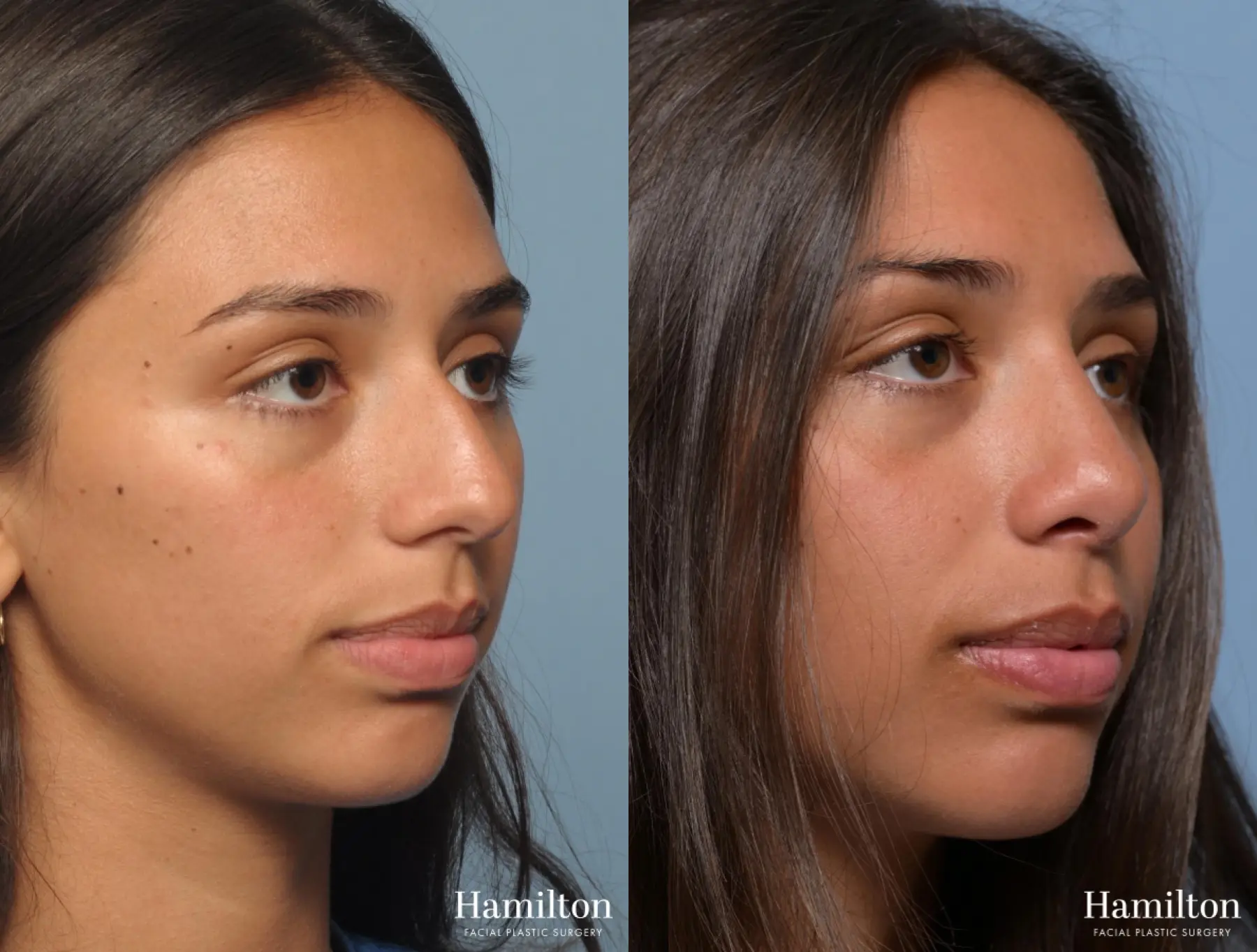 Rhinoplasty: Patient 2 - Before and After 4