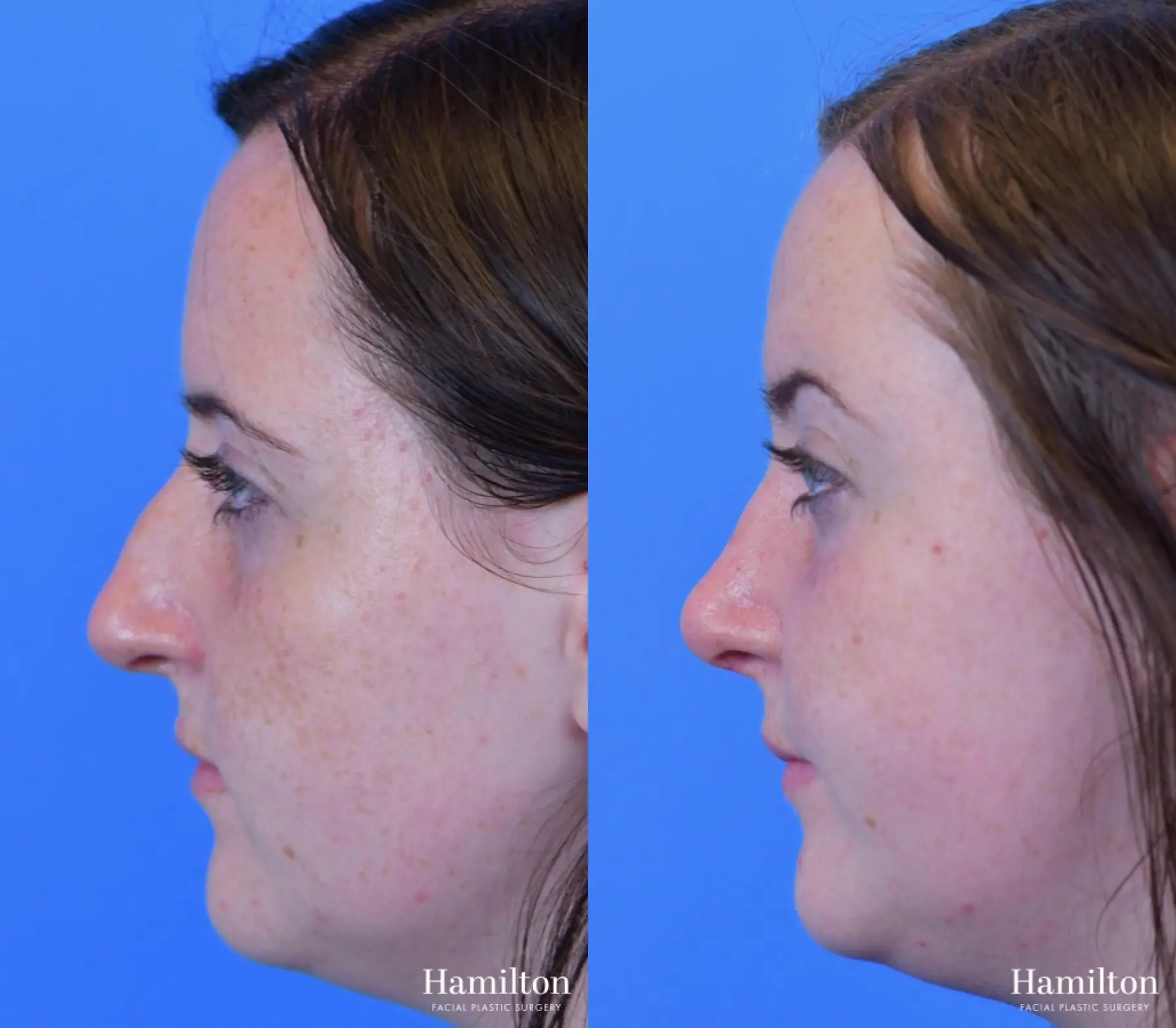 Rhinoplasty: Patient 23 - Before and After 1