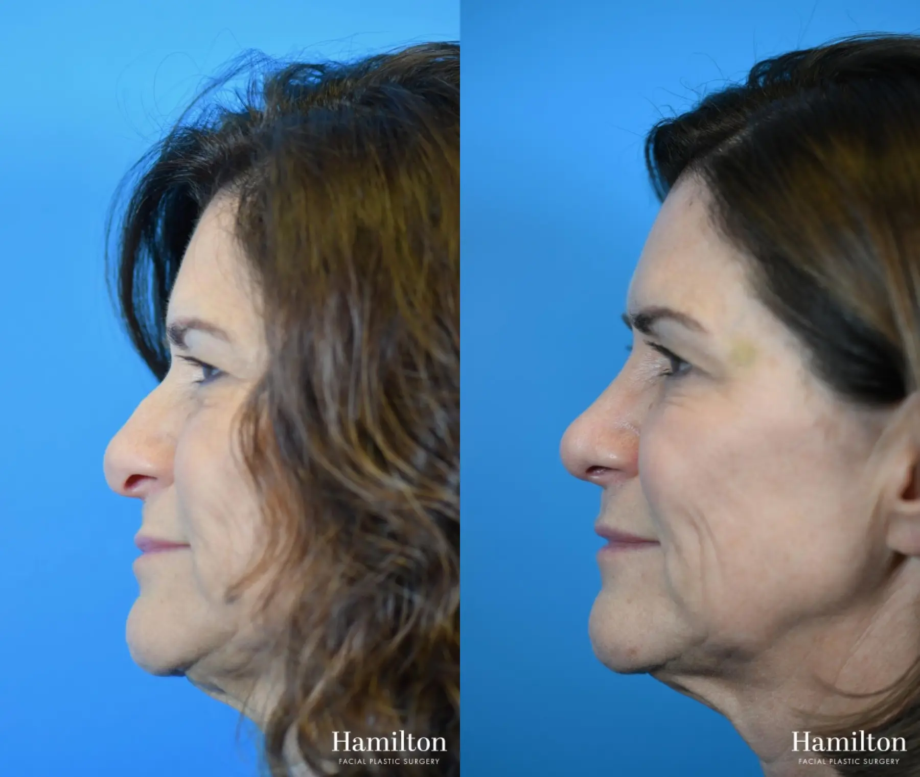 Rhinoplasty: Patient 14 - Before and After 2