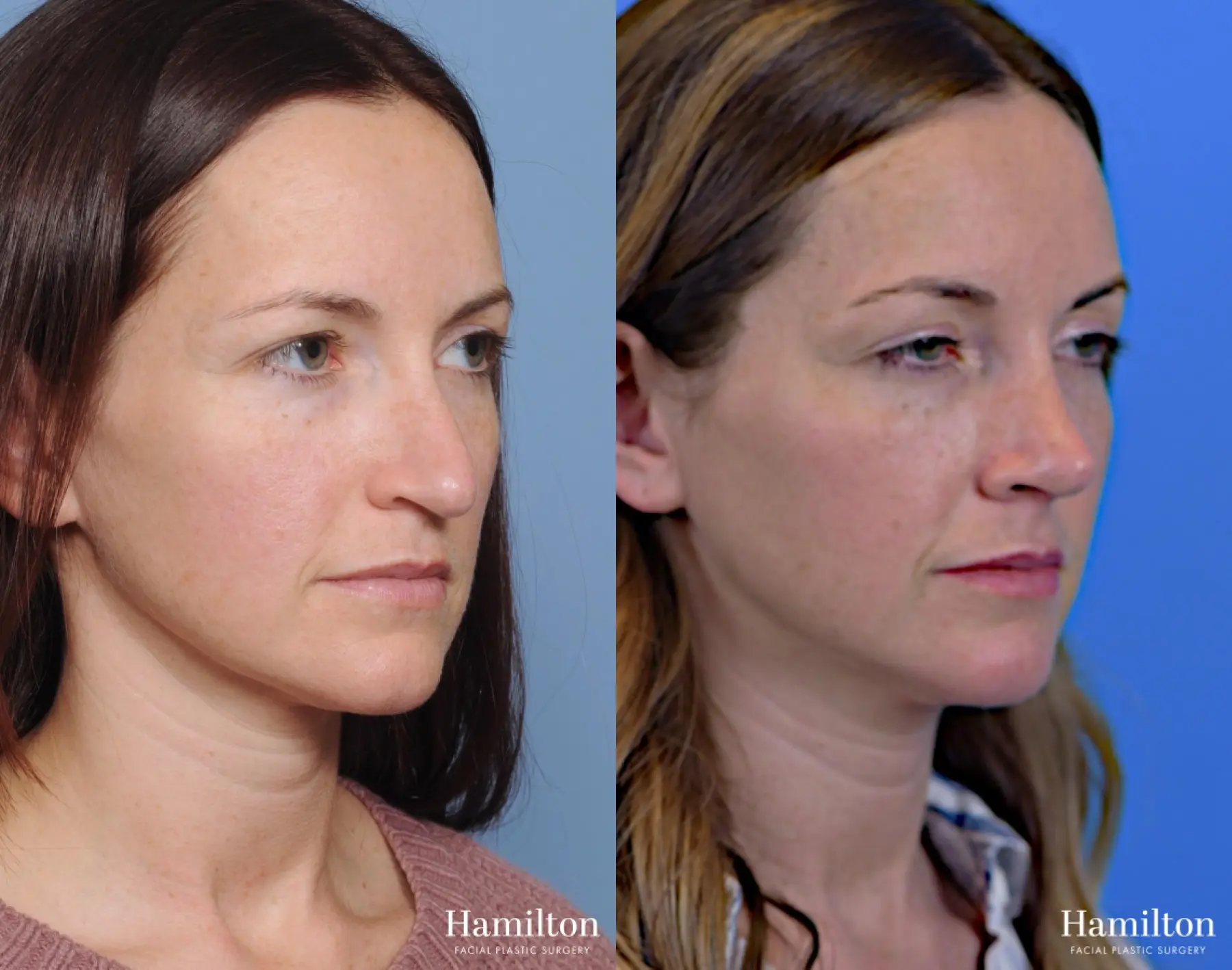 Rhinoplasty: Patient 4 - Before and After 2