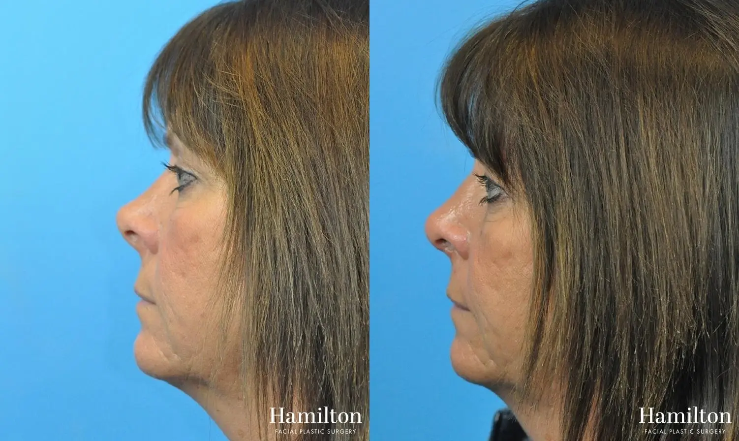 Rhinoplasty: Patient 48 - Before and After 2