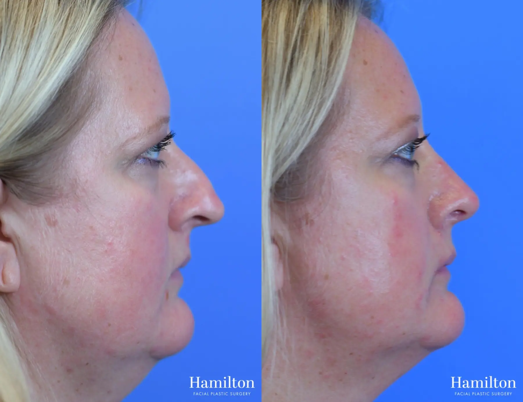 Rhinoplasty: Patient 18 - Before and After 1