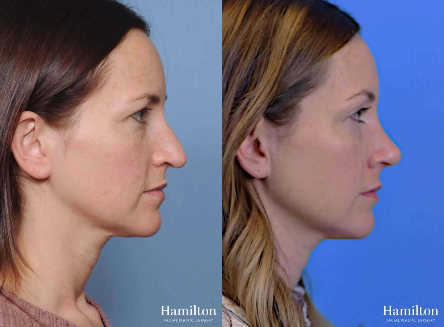 Rhinoplasty: Patient 5 - Before and After  
