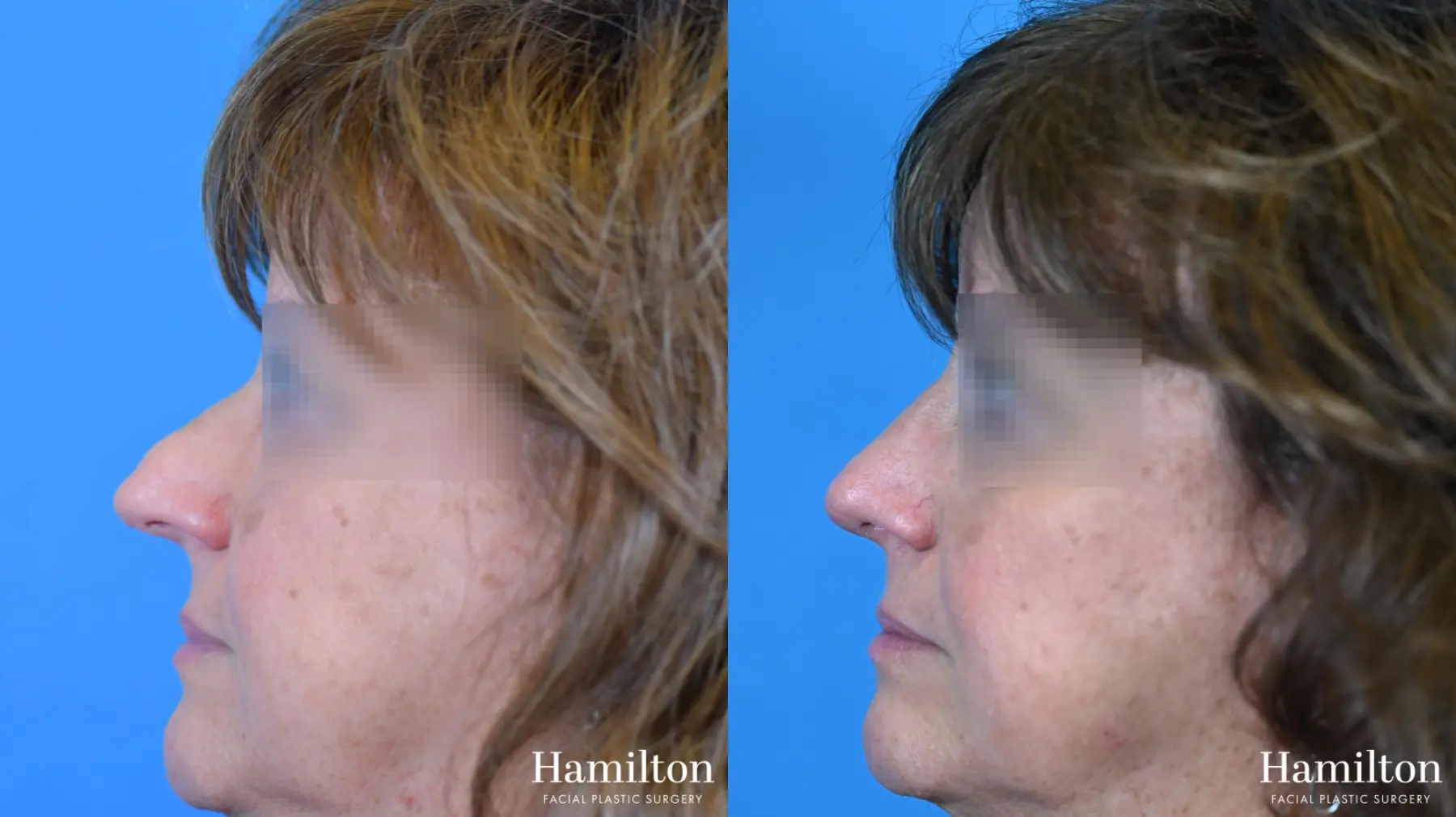 Rhinoplasty: Patient 21 - Before and After 1