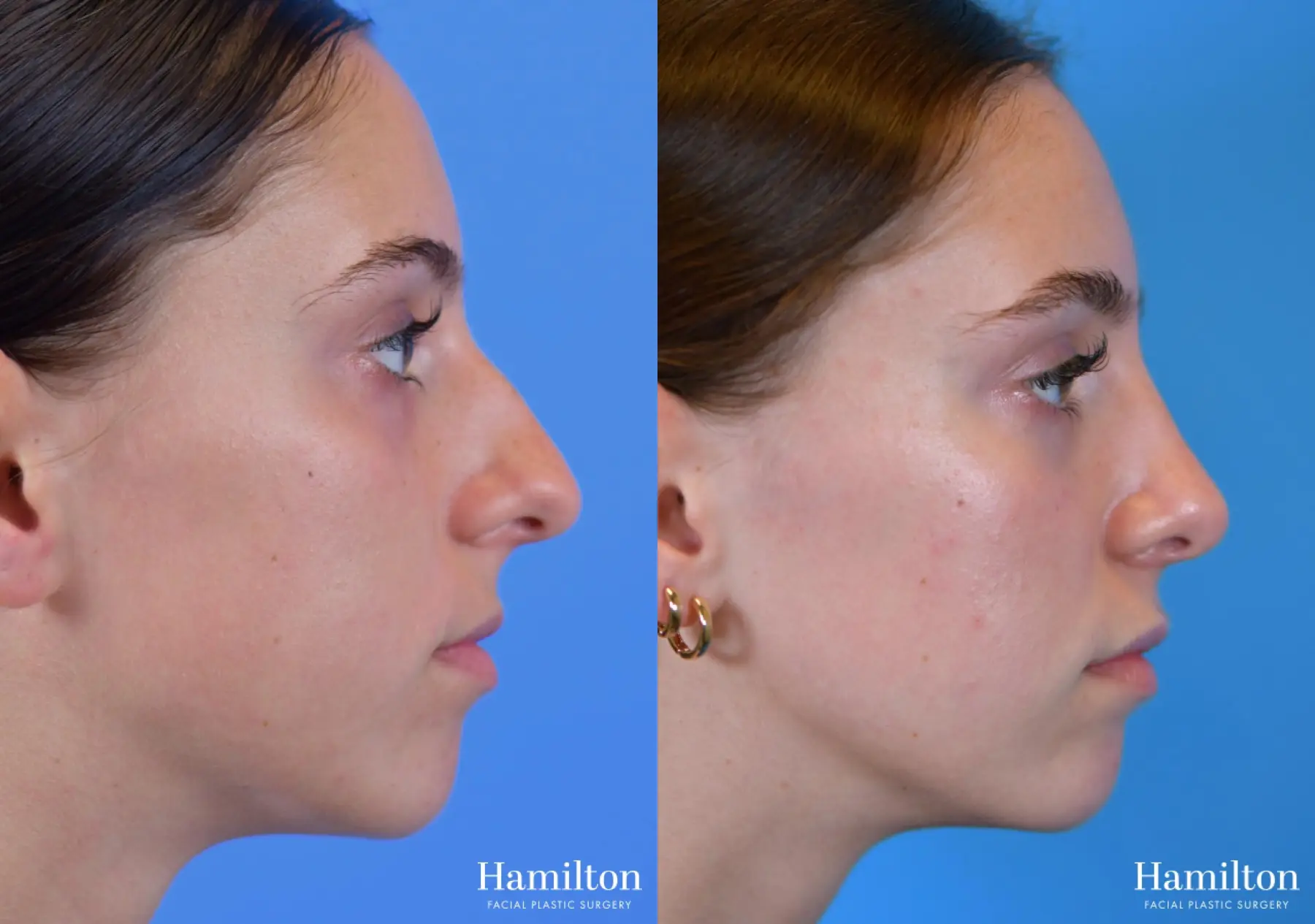 Rhinoplasty: Patient 2 - Before and After  