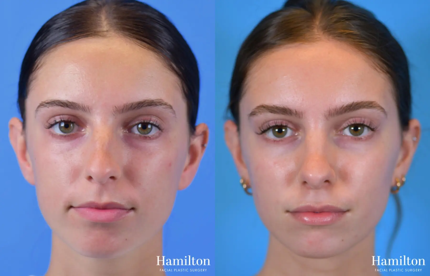 Rhinoplasty: Patient 3 - Before and After 3