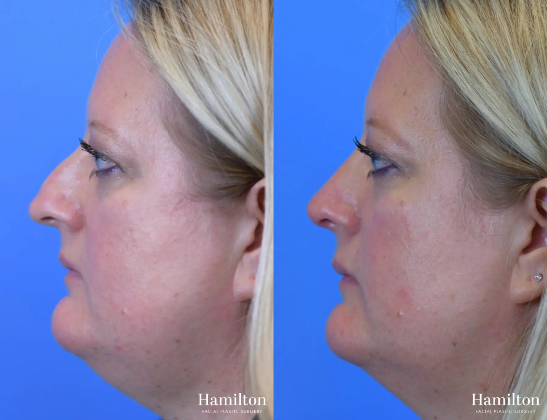 Rhinoplasty: Patient 18 - Before and After 2