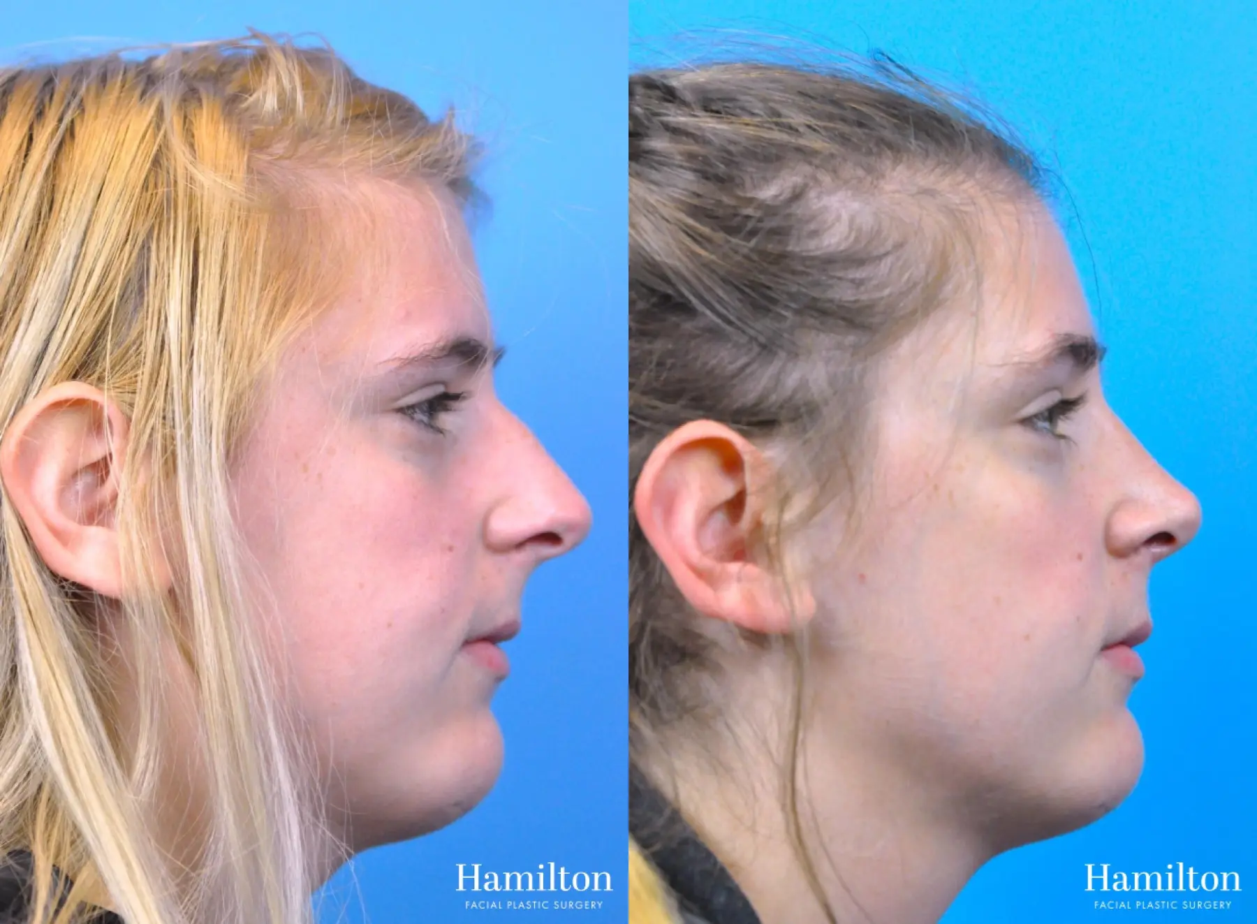 Rhinoplasty: Patient 50 - Before and After 1