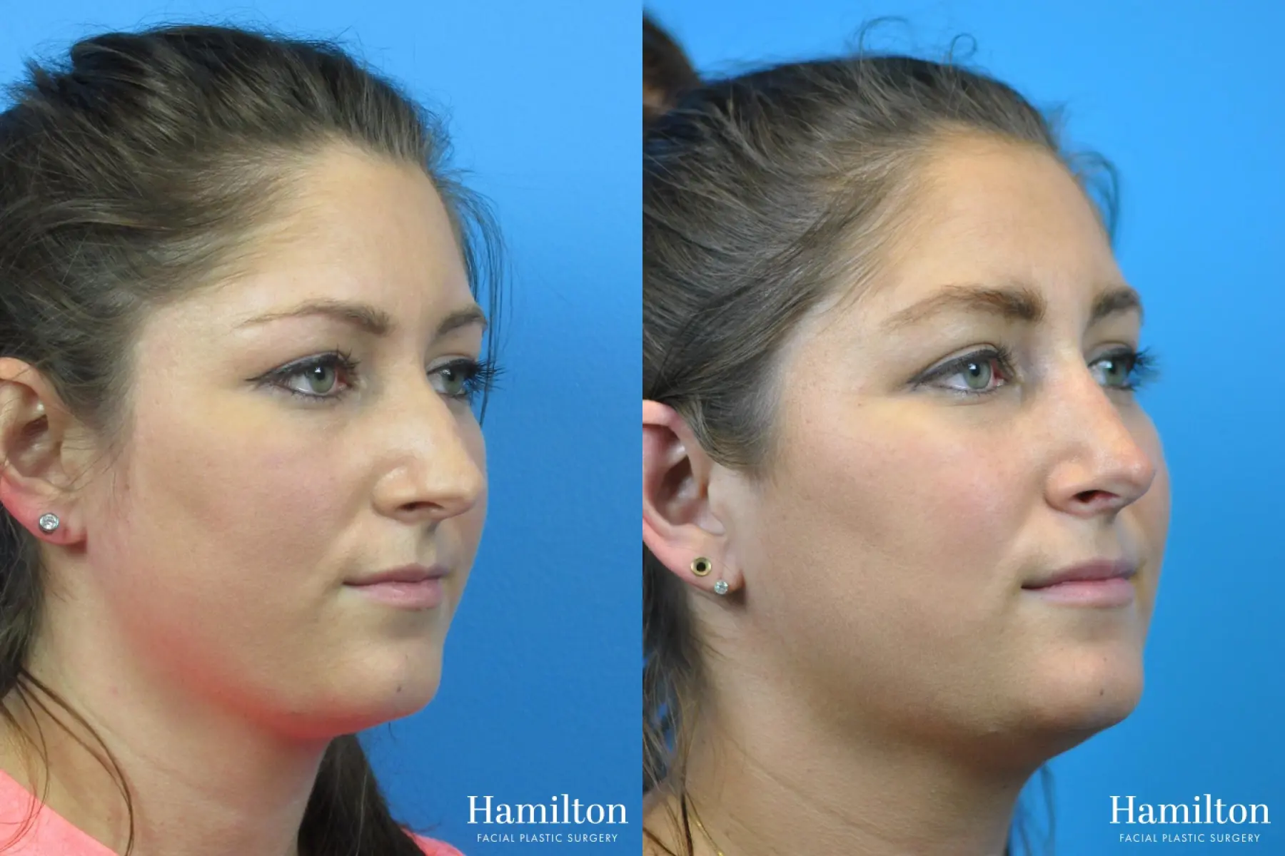 Rhinoplasty: Patient 34 - Before and After 4