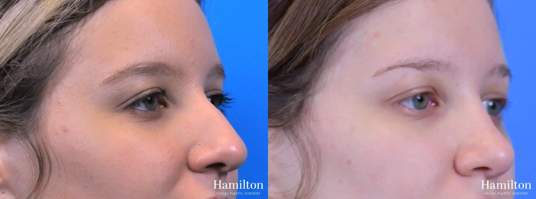 Rhinoplasty: Patient 20 - Before and After 3