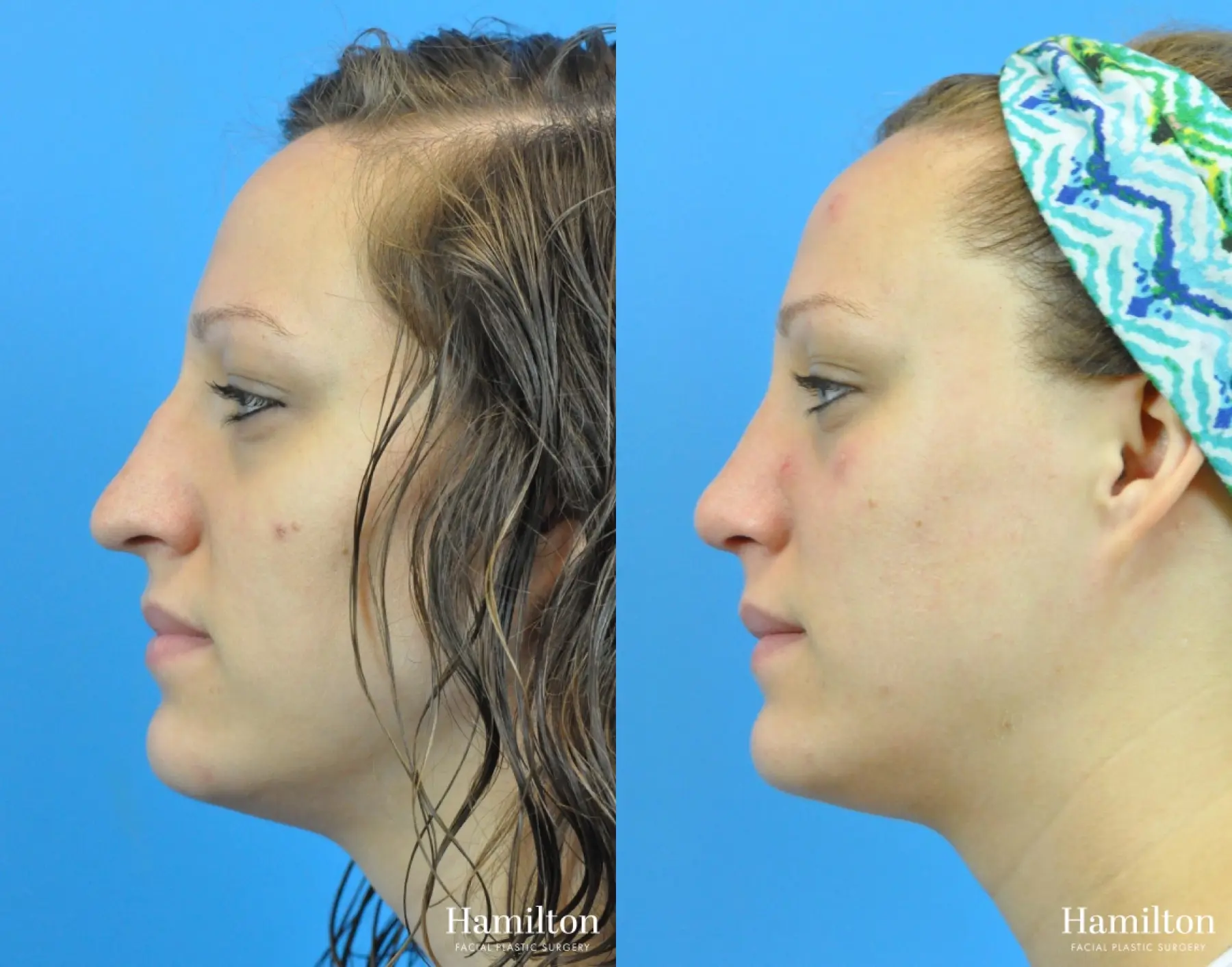 Rhinoplasty: Patient 51 - Before and After 1