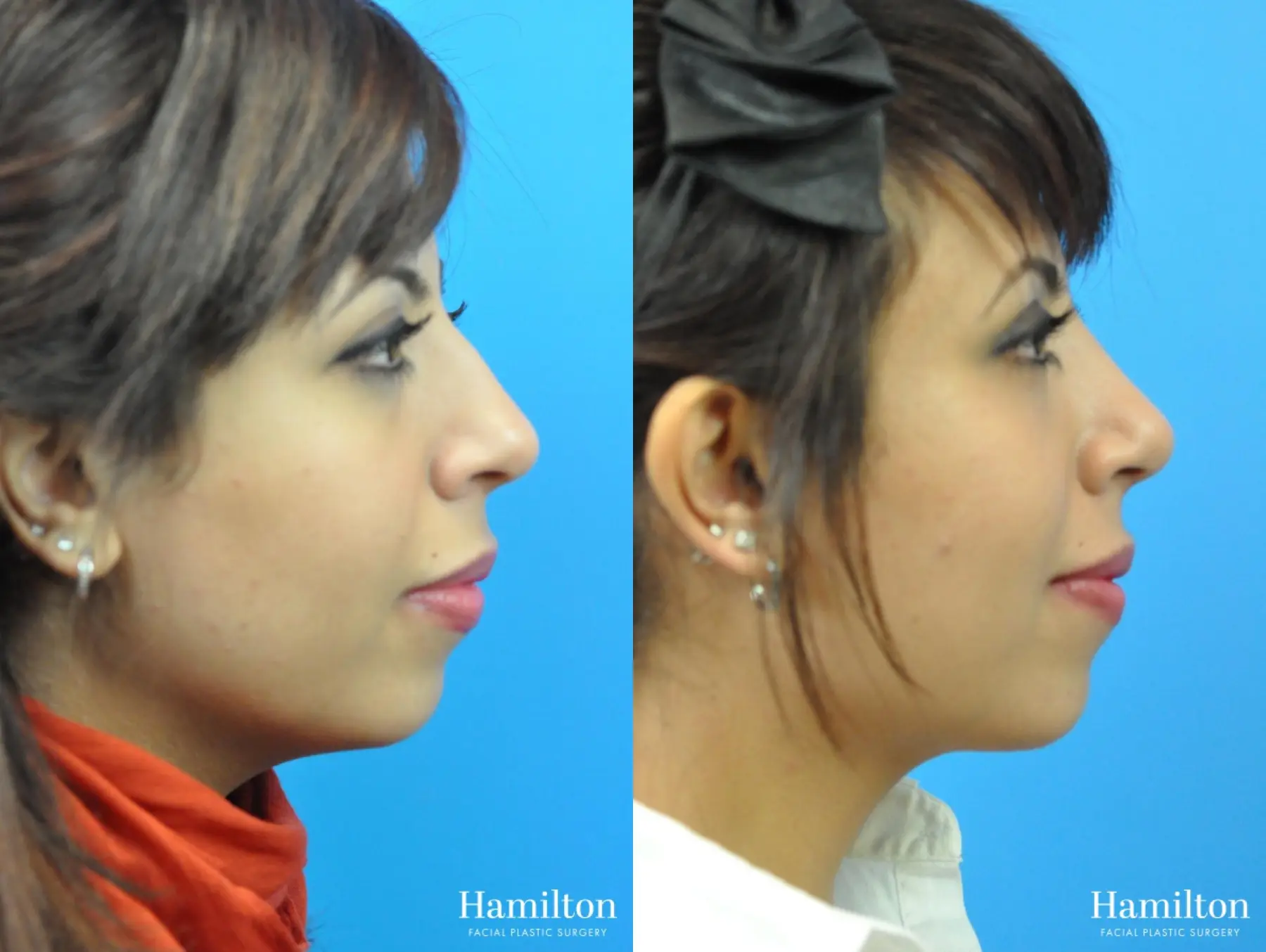 Rhinoplasty: Patient 11 - Before and After 3