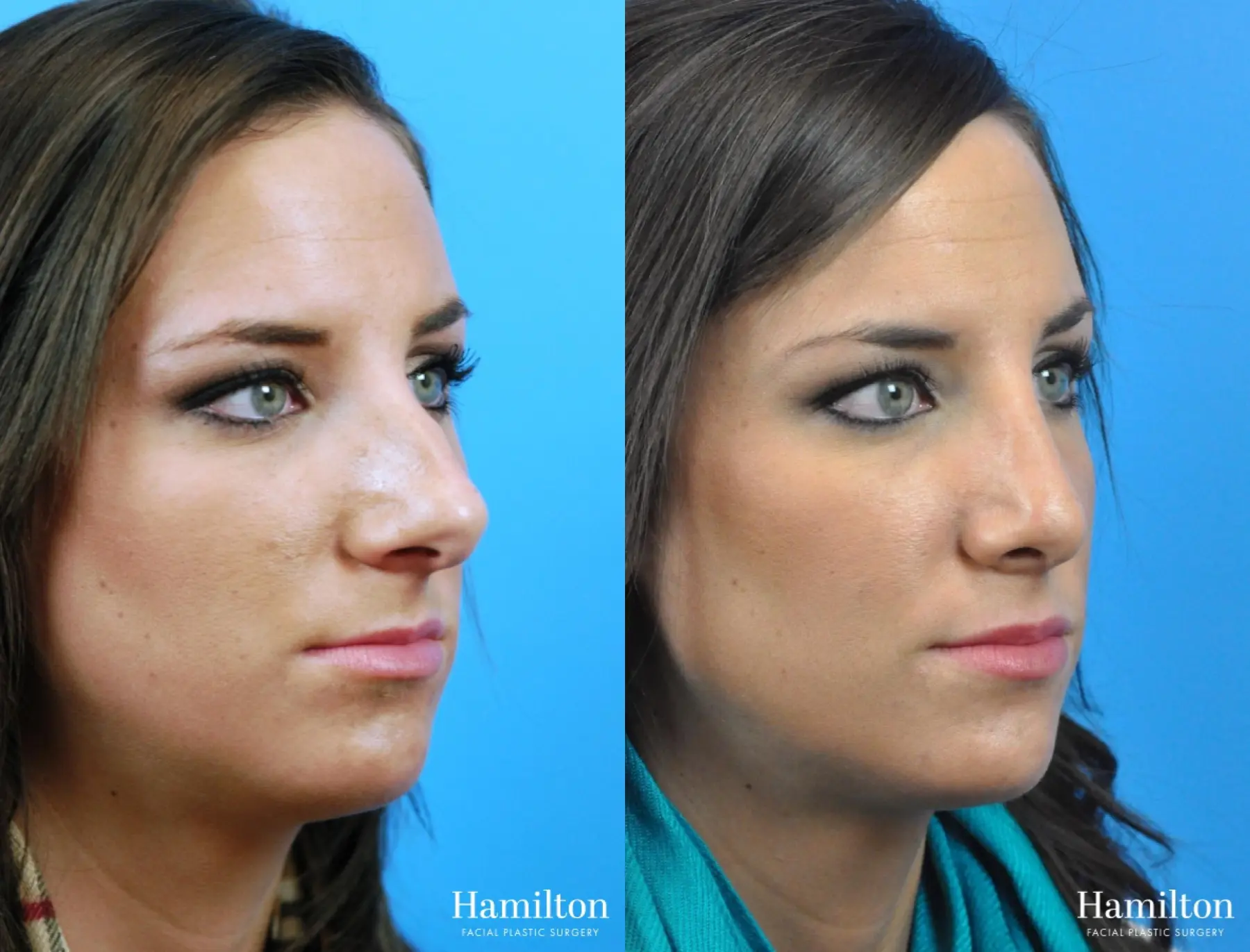 Rhinoplasty: Patient 27 - Before and After 3