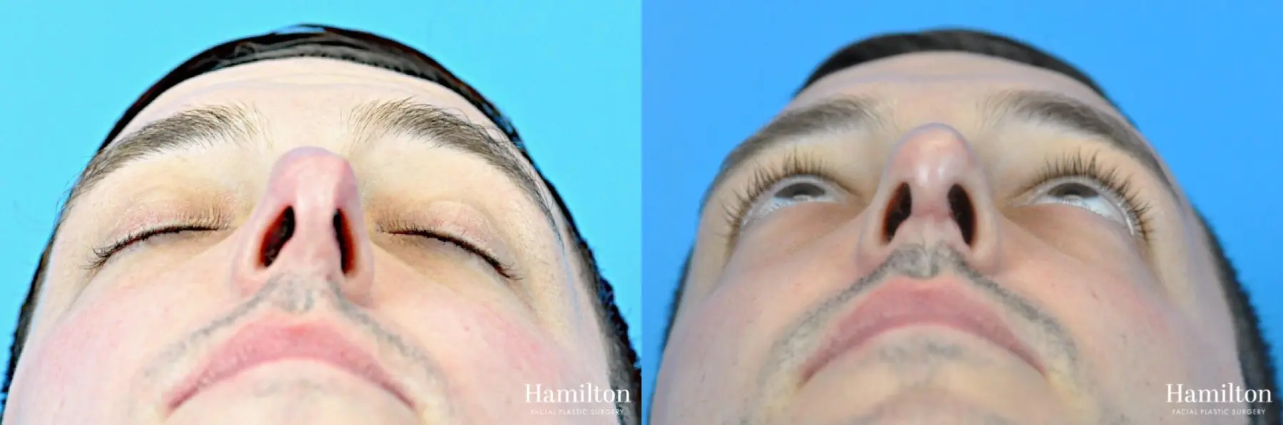 Rhinoplasty: Patient 40 - Before and After 2