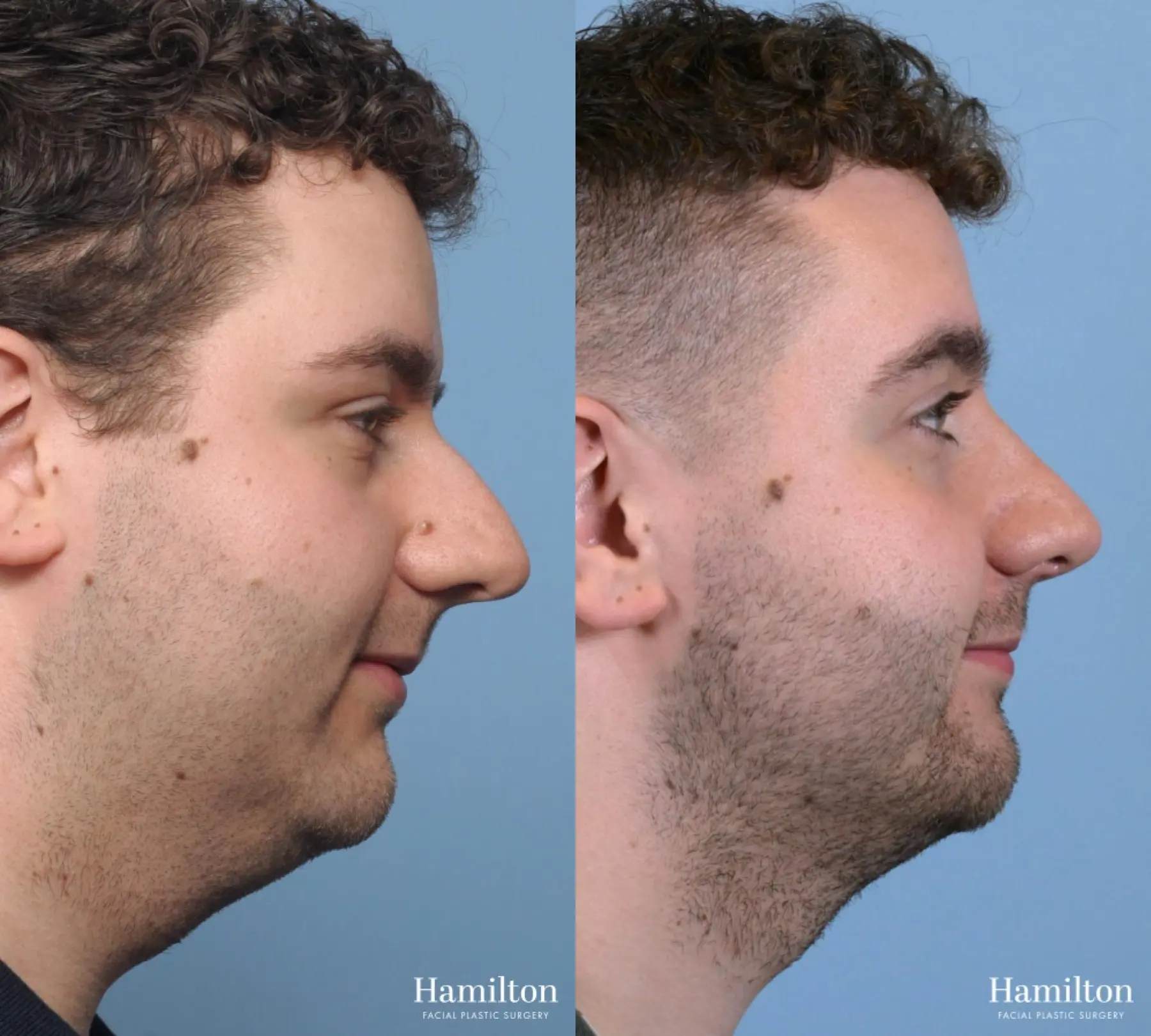 Rhinoplasty: Patient 10 - Before and After 2