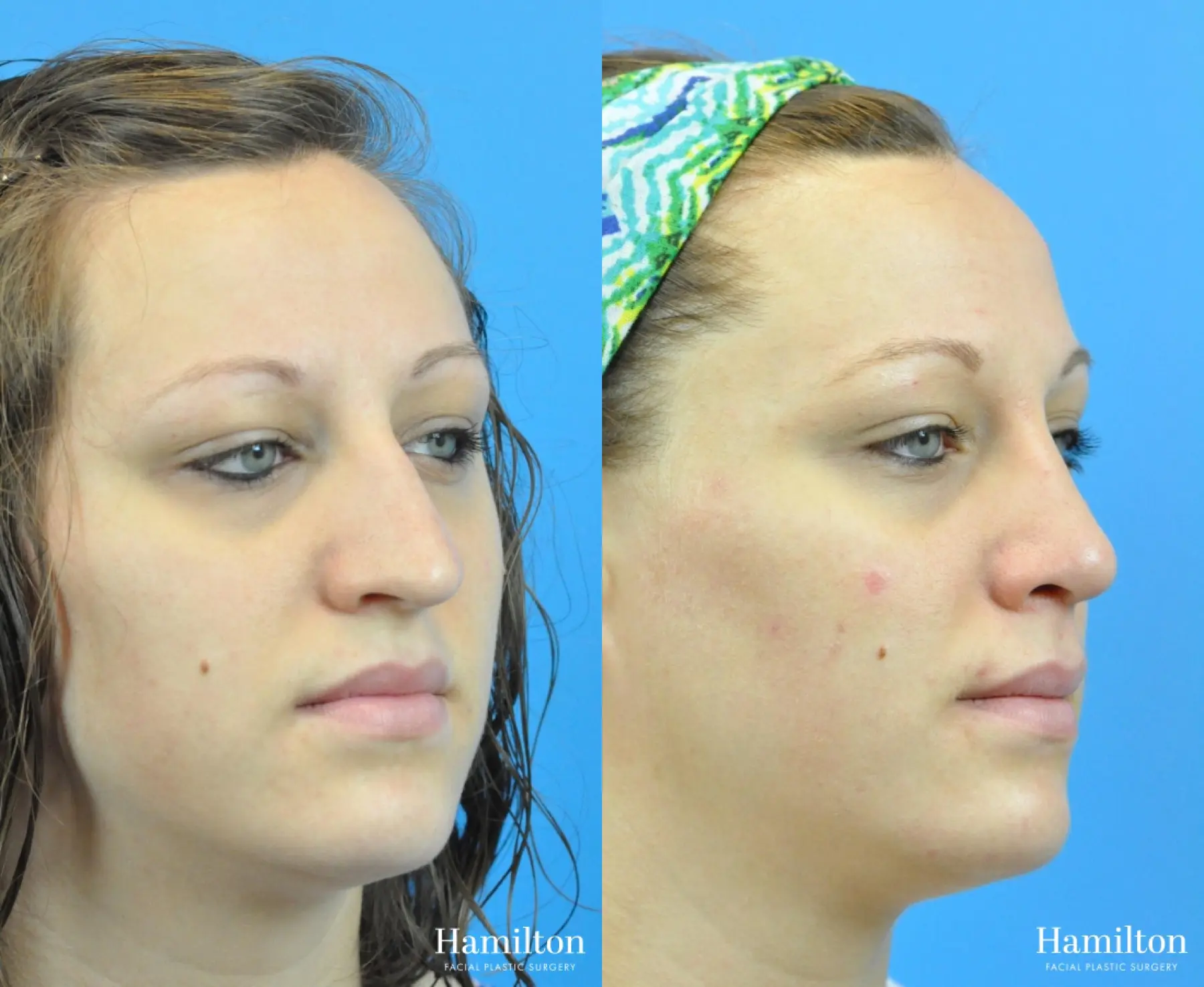 Rhinoplasty: Patient 51 - Before and After 2