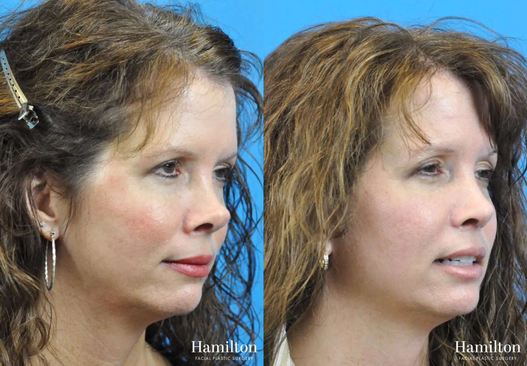 Rhinoplasty: Patient 26 - Before and After 2