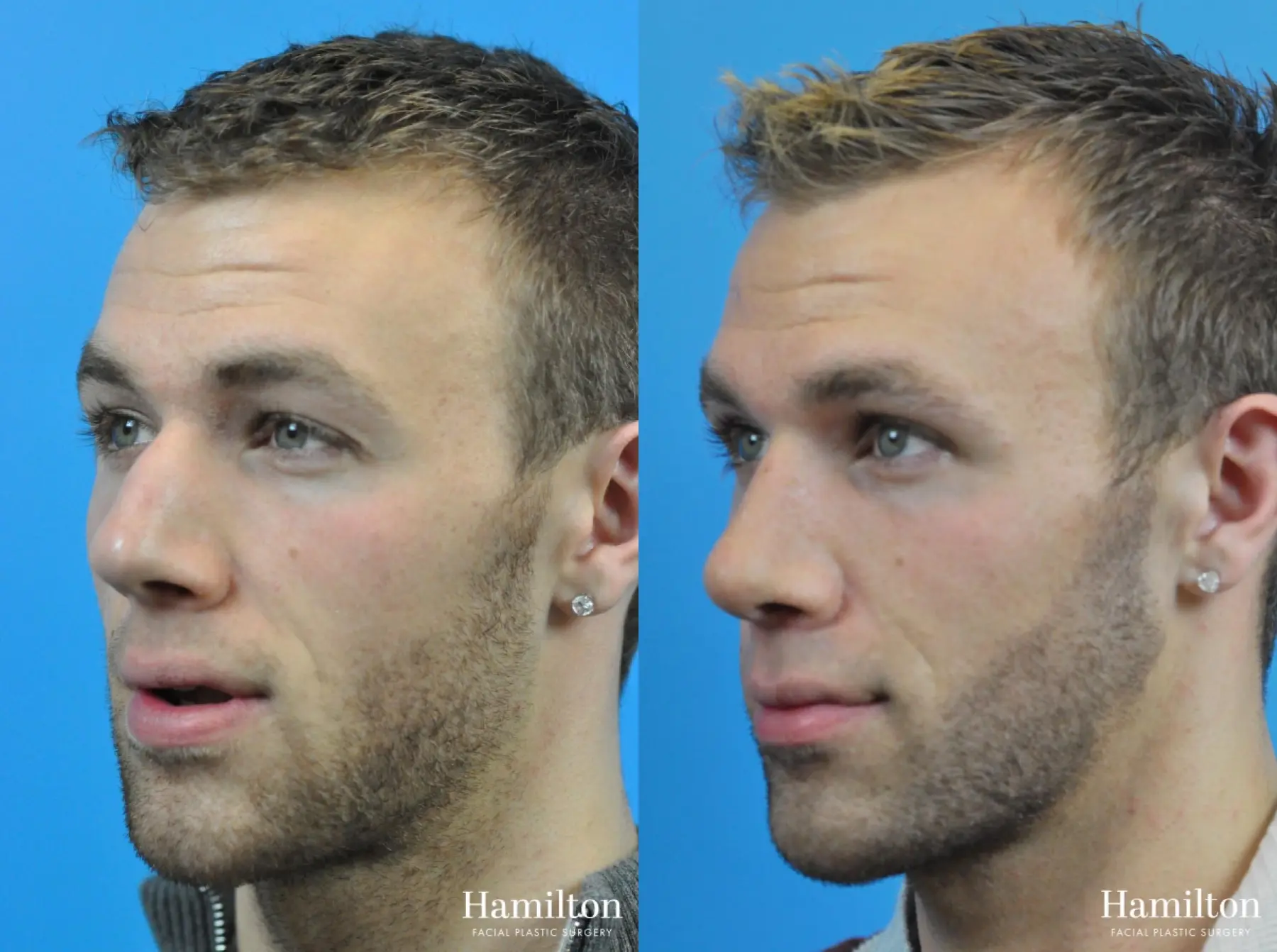 Rhinoplasty: Patient 7 - Before and After 4