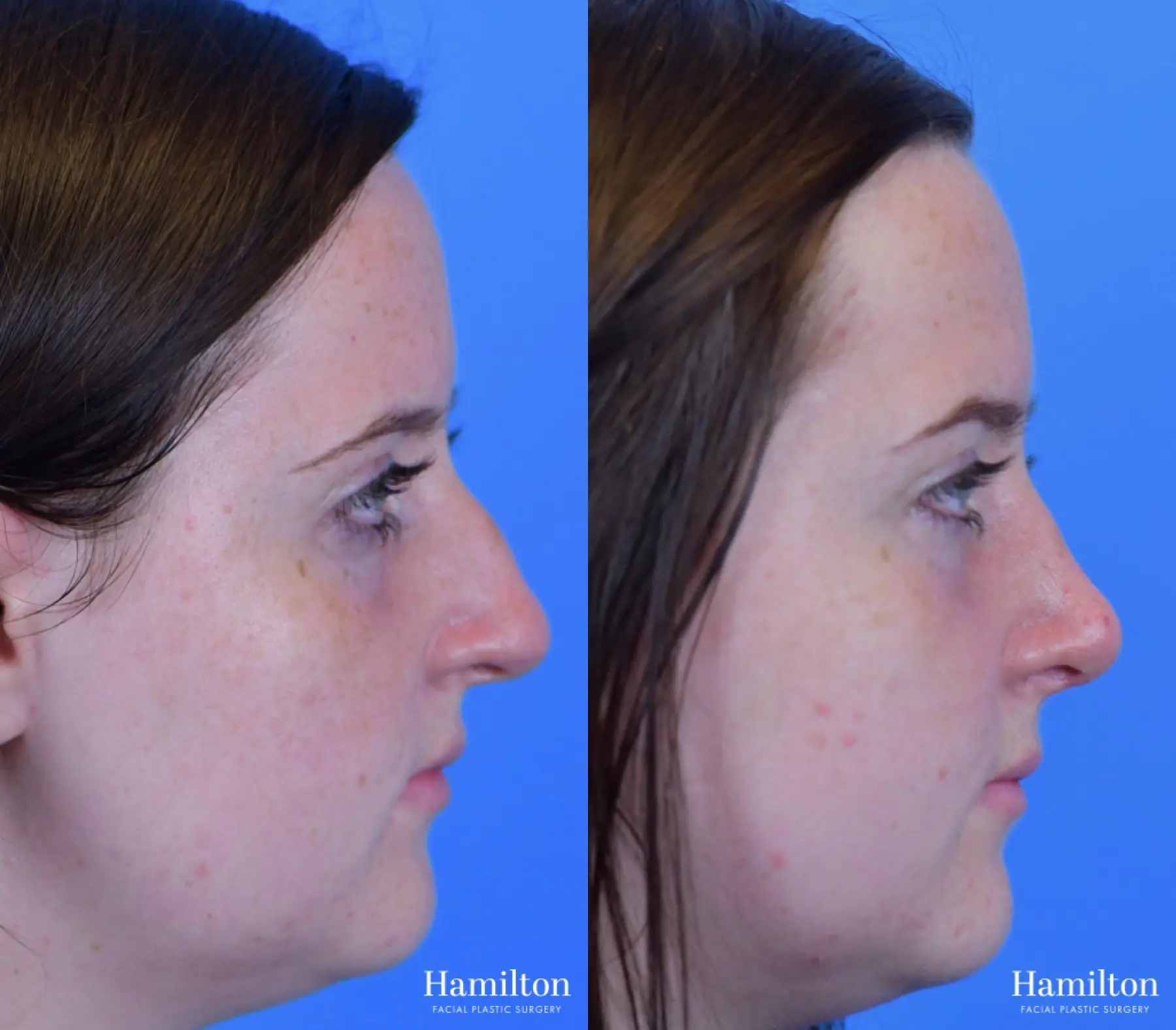 Rhinoplasty: Patient 44 - Before and After 2