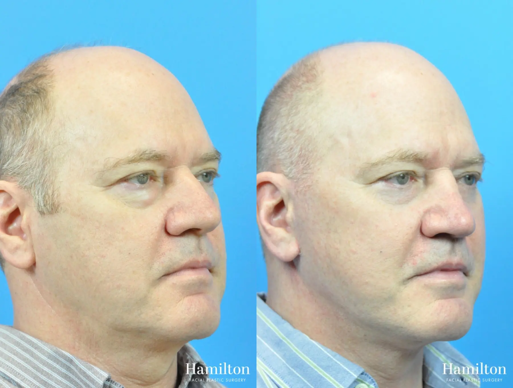 Rhinoplasty: Patient 21 - Before and After 3