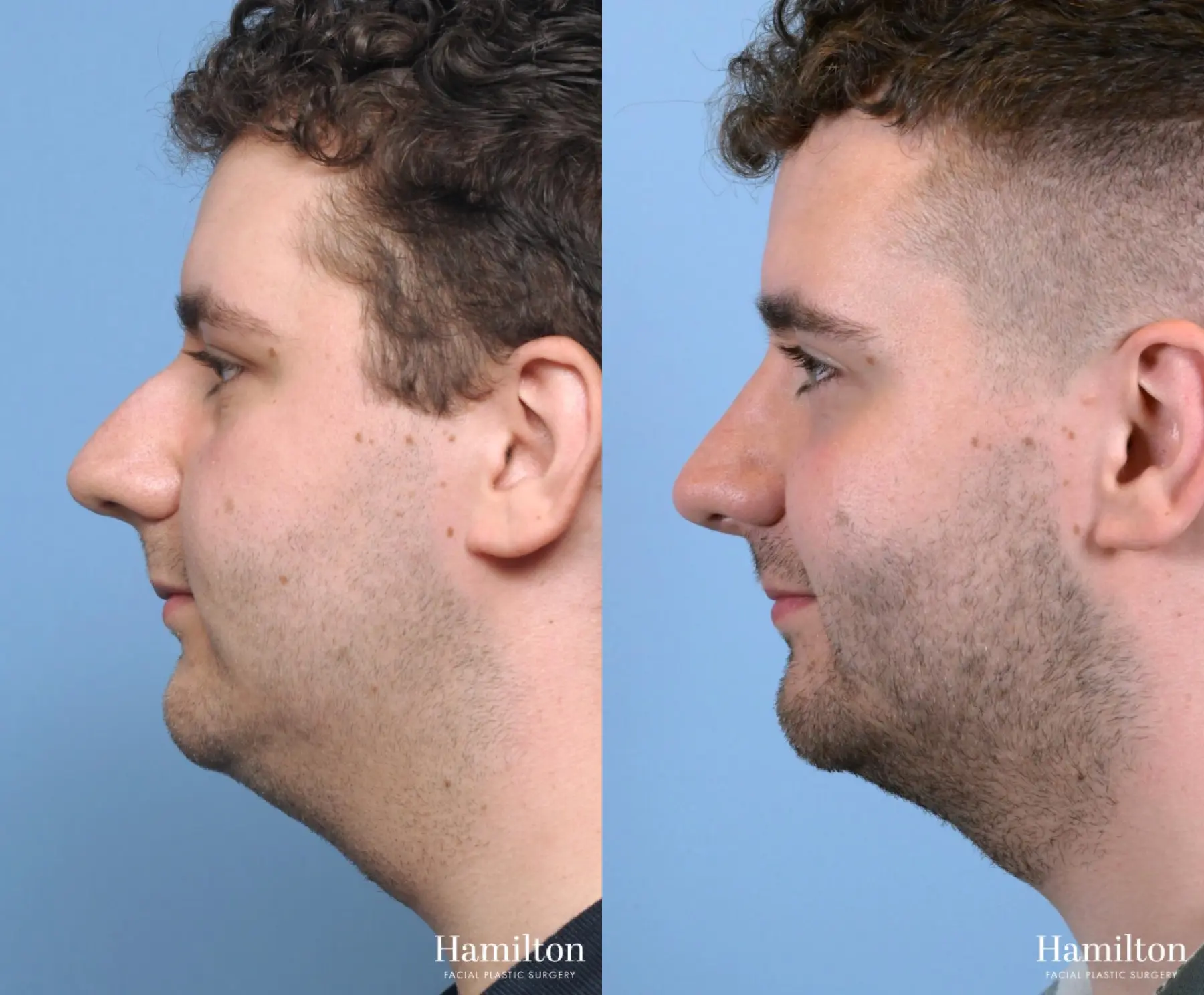 Rhinoplasty: Patient 6 - Before and After 3