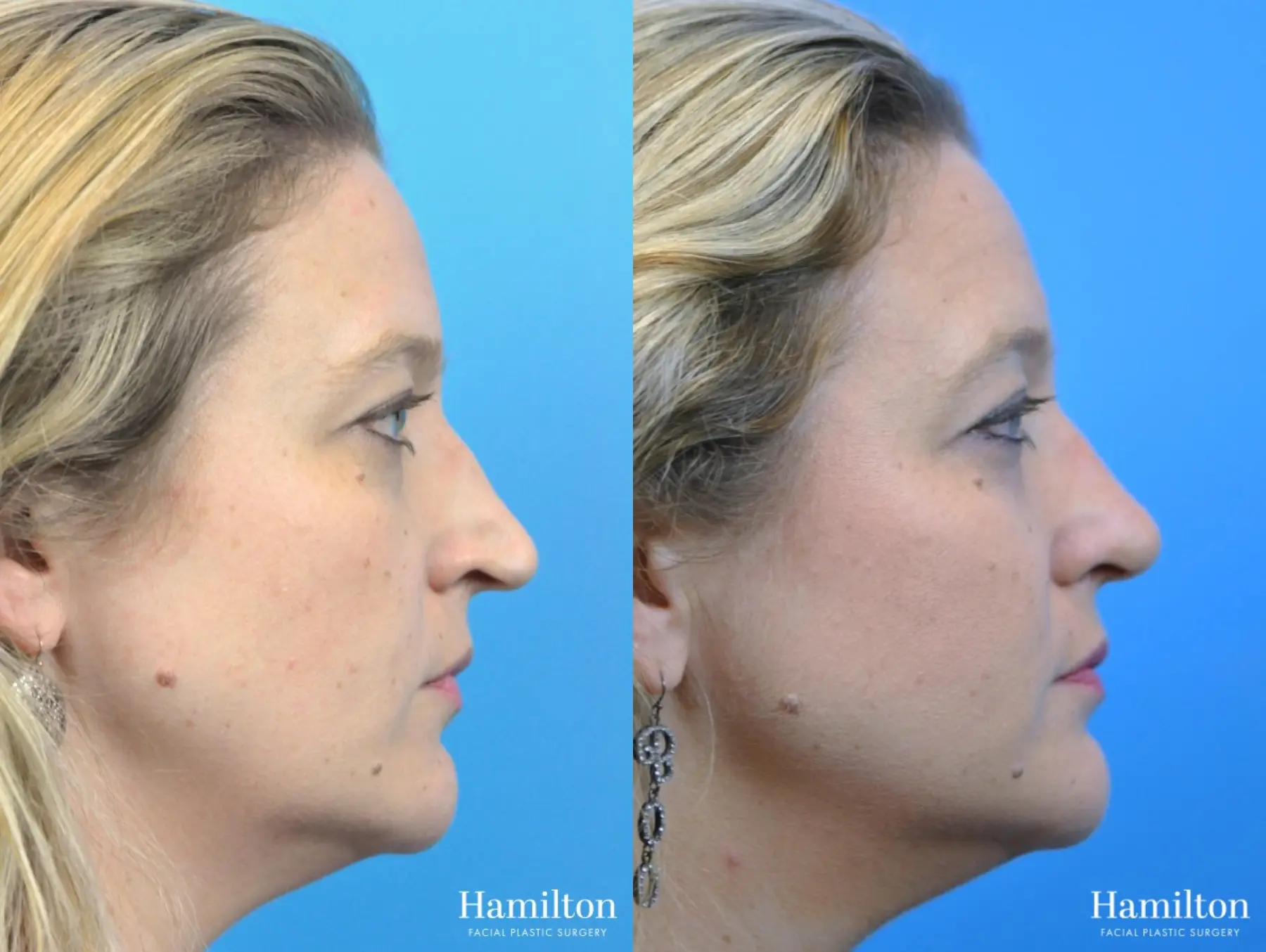 Rhinoplasty: Patient 39 - Before and After 2
