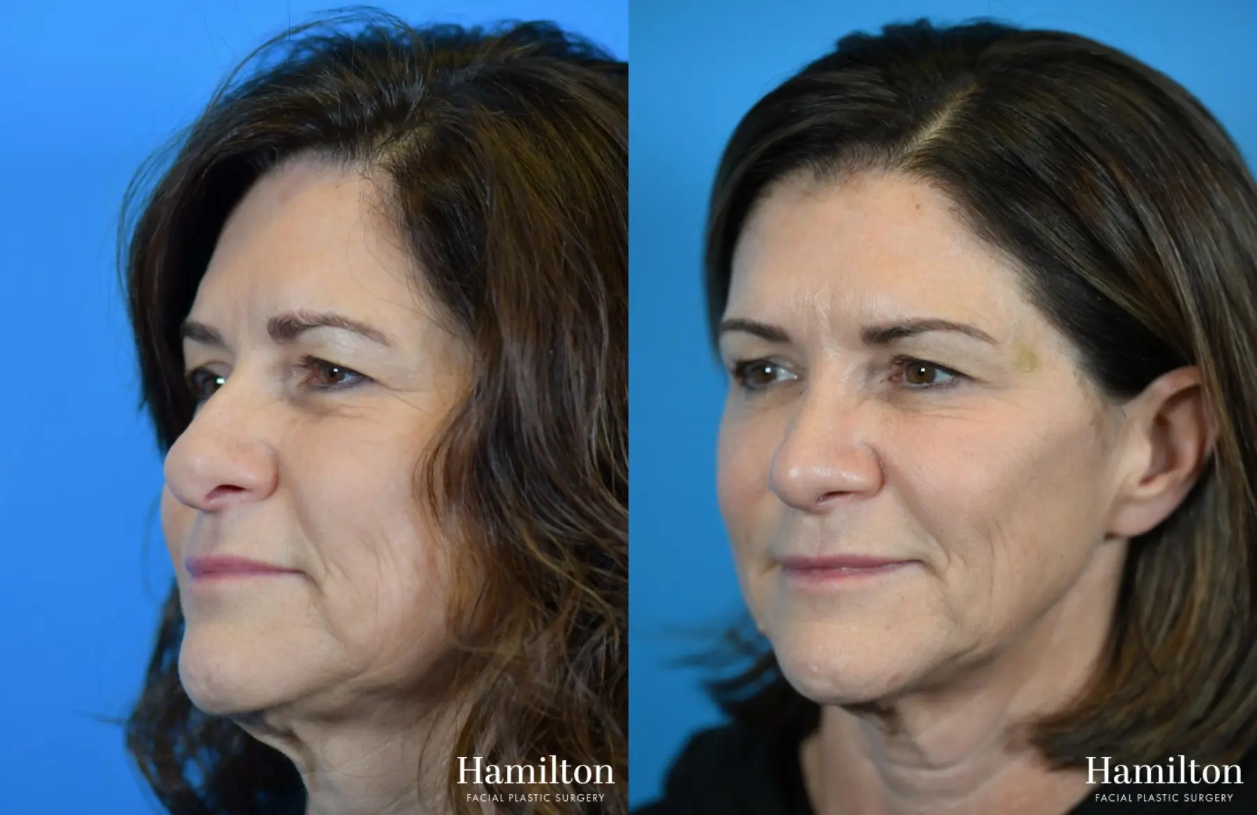 Rhinoplasty: Patient 22 - Before and After 3