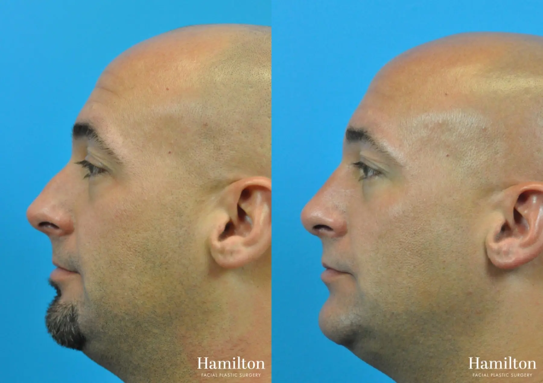 Rhinoplasty: Patient 9 - Before and After  