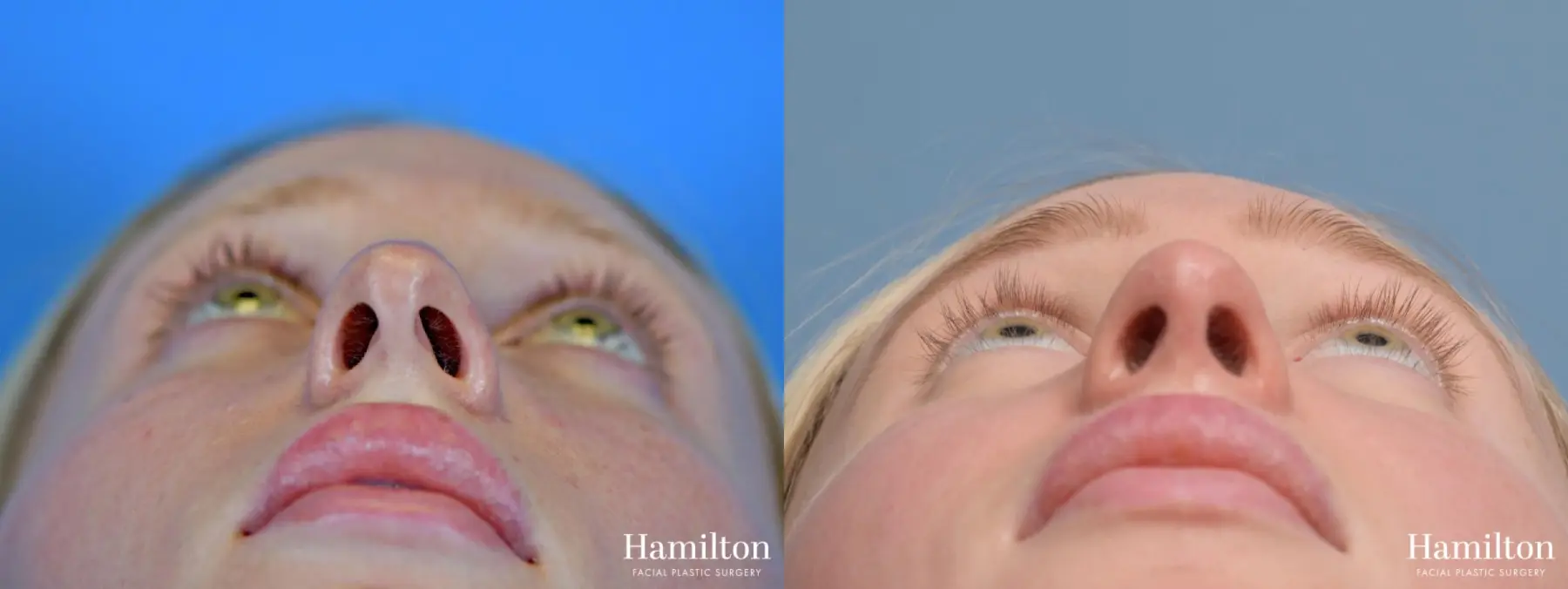 Rhinoplasty: Patient 4 - Before and After 6