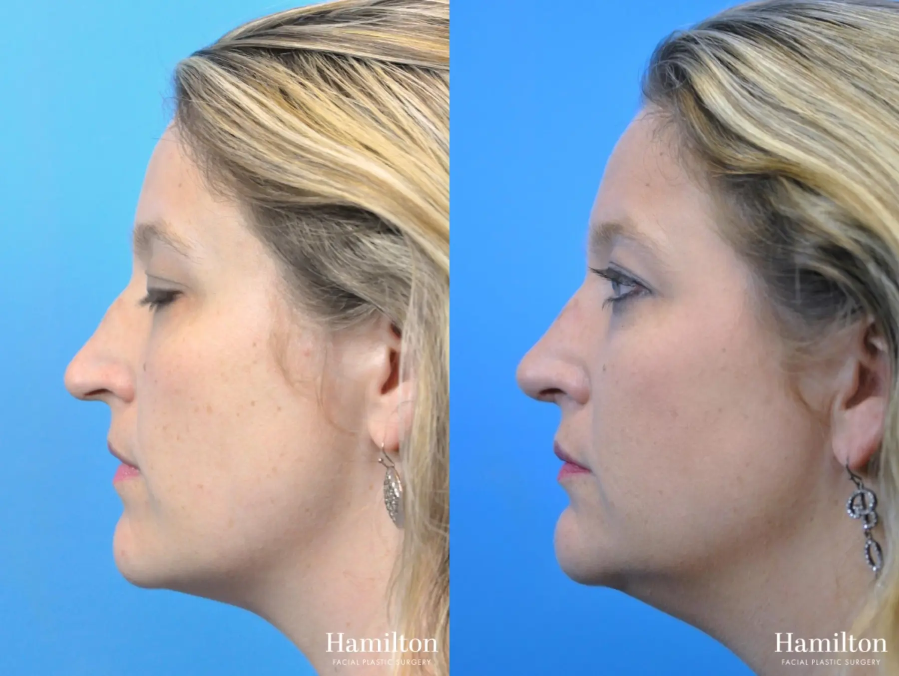 Rhinoplasty: Patient 39 - Before and After 1