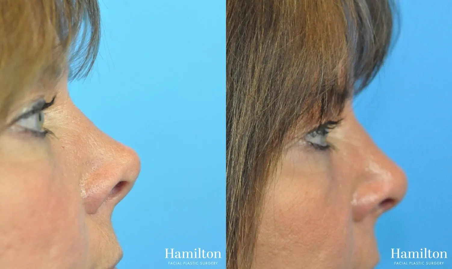 Rhinoplasty: Patient 48 - Before and After 3