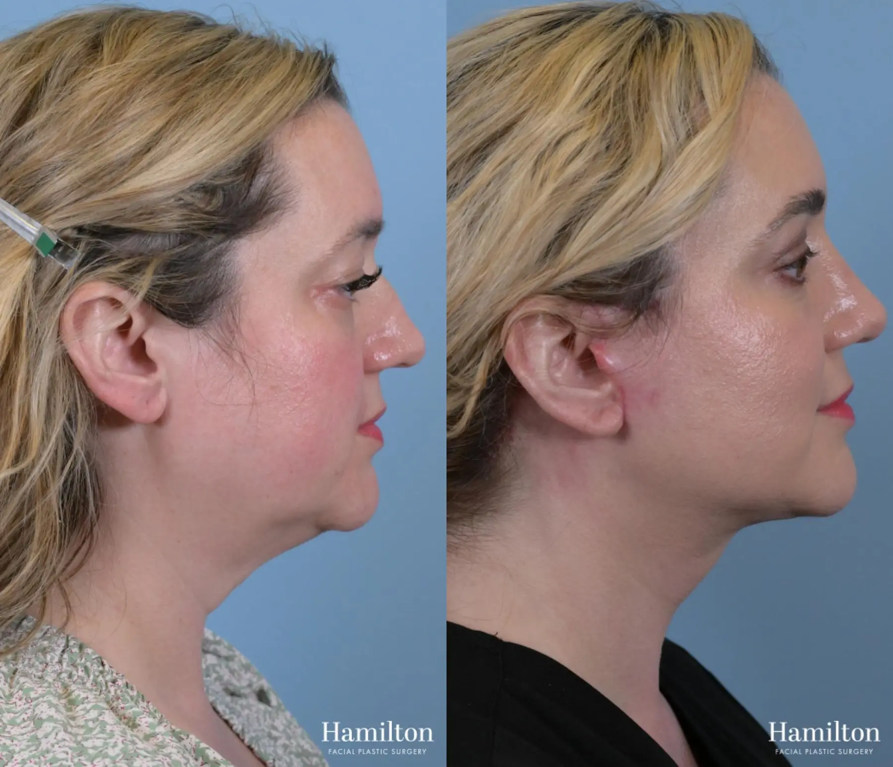 Rhinoplasty: Patient 17 - Before and After 2