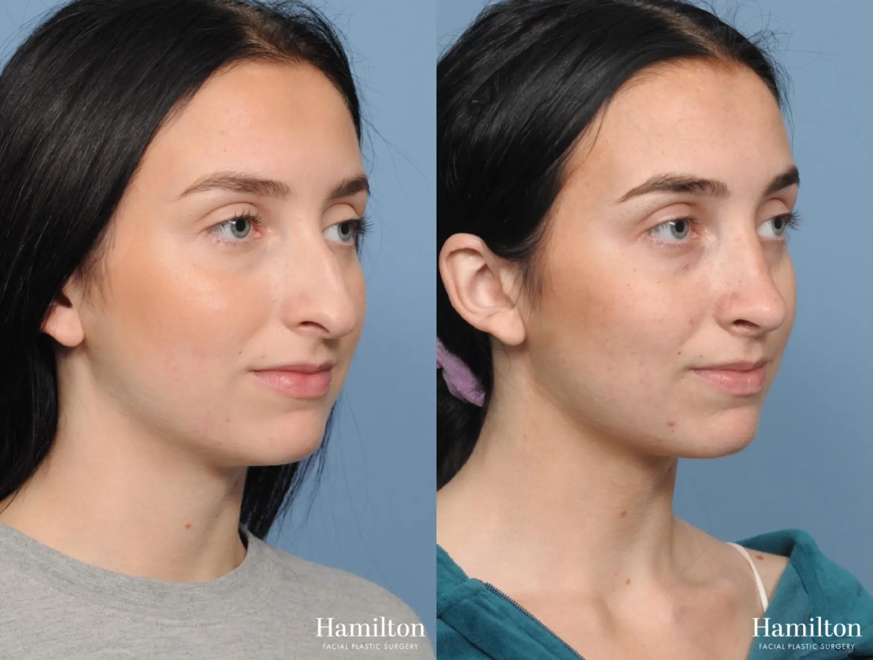 Rhinoplasty: Patient 2 - Before and After 4
