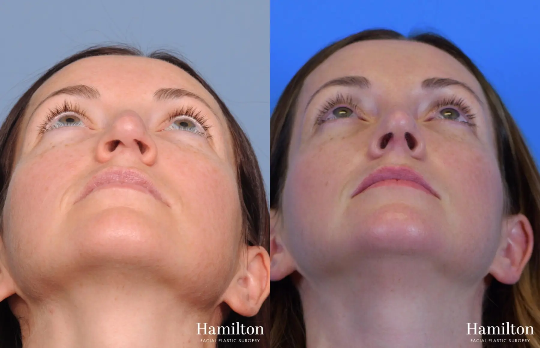 Rhinoplasty: Patient 4 - Before and After 5
